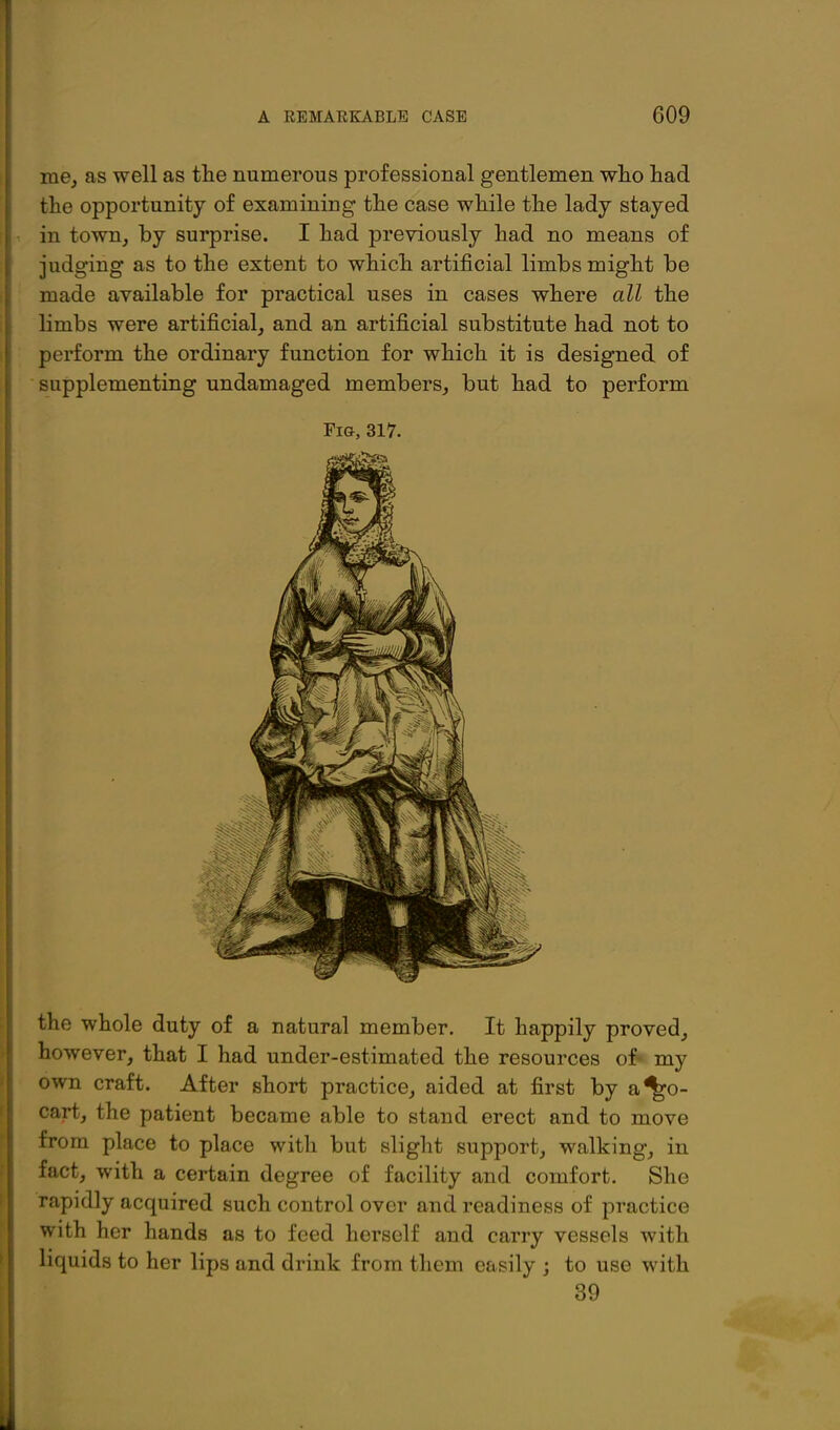 me, as well as tlie numerous professional gentlemen who had the opportunity of examining the case while the lady stayed in towTij by surprise. I had previously had no means of judging as to the extent to which artificial limbs might be made available for practical uses in cases where all the limbs were artificial, and an artificial substitute had not to perform the ordinary function for which it is designed of supplementing undamaged members, but had to perform Fia, 317. the whole duty of a natural member. It happily proved, however, that I had under-estimated the resources of* my own craft. After short practice, aided at first by a%o- cart, the patient became able to stand erect and to move from place to place with but slight support, walking, in fact, with a certain degree of facility and comfort. She rapidly acquired such control over and readiness of practice with her hands as to feed herself and carry vessels with liquids to her lips and drink from them easily j to use with 39
