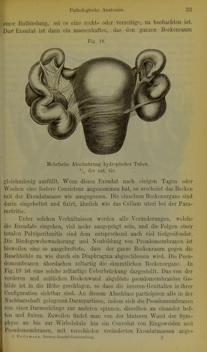 oiuor Entbindung, sei qs eine reclit- oder vorzeitige, zu beobachten ist. Das» Exsudat ist dann ein massenhaftes, das den ganzen Beckenraum Fig. 18. Mehrfache Abschnürung hydropischer Tuhcn. */. der nat. Gr. gloichmässig ausfüllt. Wenn dieses Exsudat nach einigen Tagen oder Wochen eine festere Consistenz angenommen hat, so erscheint das Becken mit der Exsudatmasse wie ausgegossen. Die einzelnen Beckenorgane sind darin eingebettet und fixirt, ähnlich wie das Collum uteri bei der Para- metritis. Unter solchen Verhältnissen werden alle Veränderungen, welche die Exsudate eingehen, viel mehr ausgeprägt sein, und die Folgen einer totalen Pelviperitonitis sind dem entsprechend auch viel tiefgreifender. Die Bindegewebswucherung imd Neubildung von Pseudomembranen ist bisweilen eine so ausgebreitete, dass der ganze Beckenraum gegen die Bauchhöhle zu wie durch ein Diaphragma abgeschlossen wird. Die Pseu- domembranen überdachen zeltartig die sämmtlichen Beckenorgane. In Fig. 19 ist eine solche zeltartige üeberbrückung dargestellt. Das von der vorderen und seitlichen Beckenwand abgelöste pseudomembranöse Ge- bilde ist in die Höhe geschlagen, so dass die inneren Genitalien in ihrer Configuration sichtbar sind. An diesem Abschluss participiren alle in der Nachbarschaft gelegenen Darmpartieen, indem sich die Pseudomembranen von einer Darmschliugo zur anderen spinnen, dieselben an einander hef- ten und fixiren. Zuweilen findet man von der hinteren Wand der Sym- physe an bis zur Wirbelsäule hin ein Convolut von Eingeweiden und Pseudomembranen, mit verschieden veränderton Exsudatmassen angc*- •1. Hpilzmaiin. Hüi'kcn-Iiauchfi'lliMitzniulmii;. 3