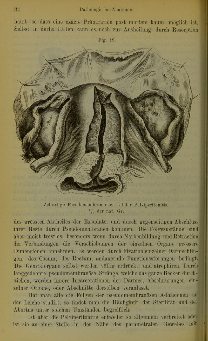 Piithologisclic Aiuitiiiiiio. häuft, so dass eine exacte Präparation post mortem kaum möglich ist. Selbst in derlei Fällen kann es noch zur Ausheilung durch Resorption Fig. 19. Zeltartige Pseudomem'bran nach totaler Pelviperitonitis. */. der nat. Gr. des grössten Antheiles der Exsudate, und durch gegenseitigen Abschluss ihrer Keste durch Pseudomembranen kommen. Die Folgezustände sind aber meist trostlos, besonders wenn durch Narbenbilduug undRetraction der Verbindungen die Verschiebungen der einzelnen Organe grösseif Dimensionen annehmen. Es werden durch Fixation einzelner Darmschliii- gen, des Cöcum, des Rectum, andauernde Functionsstörungen bedinpt. Die Genitalorgane selbst werden völlig erdrückt, und atrophiren. Dureli langgedehnte pseudomembranöse Stränge, welche das ganze Becken durcli- ziehen, werden innere Incarcerationen des Darmes, Abschnüruugeu ein- zelner Organe, oder Abschnitte derselben veranlasst. Hat man alle die Folgen der pseudomembranösen Adhäsionen an der Leiche studirt, so findet mau die Häufigkeit der Sterilität und di s Abortus unter solchen Umständen begreiflich. Ist aber die Pelviperitonitis entweder so allgemein verbreitet ode ist sie an einer Stelle . in der Nähe des parametralen Gewebes mit