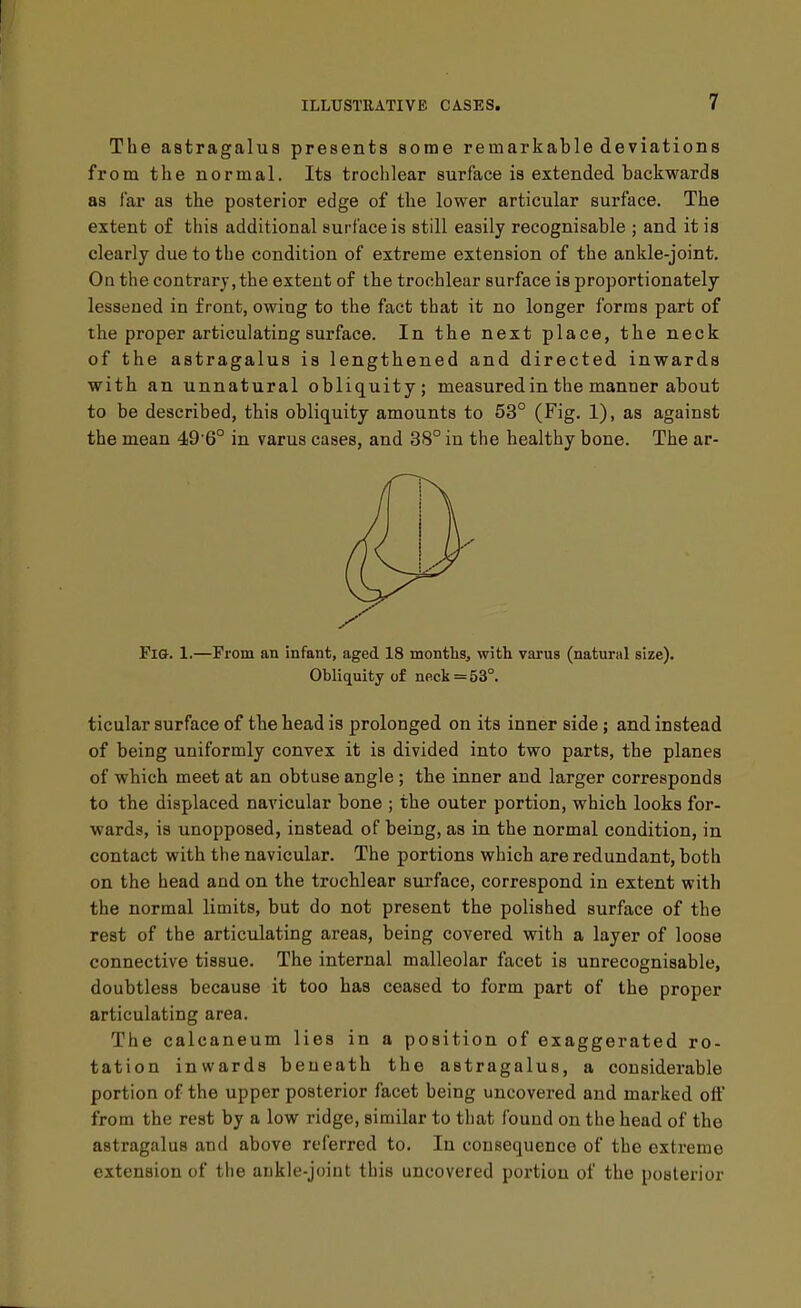 The astragalus presents some remarkable deviations from the normal. Its trochlear surface is extended backwards as far as the posterior edge of the lower articular surface. The extent of this additional surface is still easily recognisable ; and it is clearly due to the condition of extreme extension of the ankle-joint. On the contrary, the extent of the trochlear surface is proportionately lessened in front, owing to the fact that it no longer forms part of the proper articulating surface. In the next place, the neck of the astragalus is lengthened and directed inwards with an unnatural obliquity; measured in the manner about to be described, this obliquity amounts to 53° (Fig. 1), as against the mean 49'6° in varus cases, and 38° in the healthy bone. The ar- Pig. 1.—From an infant, aged 18 months^ with varus (natural size). Obliquity of neck = 53°. ticular surface of the head is prolonged on its inner side; and instead of being uniformly convex it is divided into two parts, the planes of which meet at an obtuse angle; the inner and larger corresponds to the displaced navicular bone ; the outer portion, which looks for- wards, is unopposed, instead of being, as in the normal condition, in contact with the navicular. The portions which are redundant, both on the head and on the trochlear surface, correspond in extent with the normal limits, but do not present the polished surface of the rest of the articulating areas, being covered with a layer of loose connective tissue. The internal malleolar facet is unrecognisable, doubtless because it too has ceased to form part of the proper articulating area. The calcaneum lies in a position of exaggerated ro- tation inwards beneath the astragalus, a considerable portion of the upper posterior facet being uncovered and marked off from the rest by a low ridge, similar to that found on the head of the astragalus and above referred to. In consequence of the extreme extension of the ankle-joint this uncovered portion of the posterior