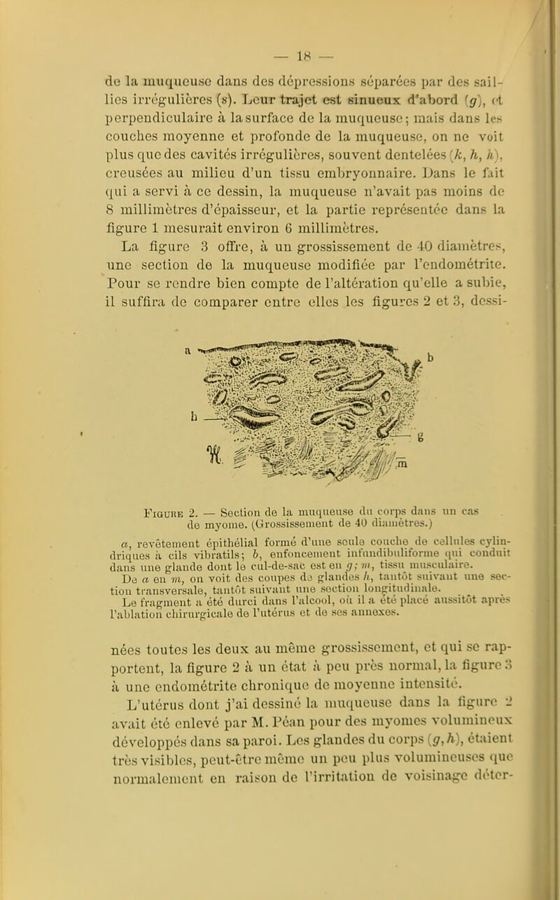de la muqueuse dans des dépressions séparées par des sail- lies irrégulières (s). Leur trajet est sinueux d'abord (g), et perpendiculaire à lasurface de la muqueuse; mais dans les couches moyenne et profonde de la muqueuse, on ne voit plus que des cavités irrégulières, souvent dentelées (/d, h, h). creusées au milieu d'un tissu embryonnaire. Dans le fait qui a servi à ce dessin, la muqueuse n'avait pas moins de 8 millimètres d'épaisseur, et la partie représentée dans la figure 1 mesurait environ 6 millimètres. La figure 3 ofire, à un grossissement de 40 diamètres, une section de la muqueuse modifiée par l'endométrite. Pour se rendre bien compte de l'altération qu'elle a subie, il suffira de comparer entre elles les figures 2 et .3, dessi- FiauiiB 2. — Seclion de la luiKiiieuse ilii corps dans un cas de myonie. (Grossissement de 40 diamètres.) a, revêtement épithélial formé d'une seule couclio de cellules cylin- driques il cils vibratils; b, enfoncement infundibuliforme (lui conduit dans une glande dont le cul-de-sac est en g; m, tissu nuisculaire. De Cl en m, on voit des coupes dj glandes h, tantôt suivant une sec- tion transversale, tantôt suivant une section longitudinale. Le fragment a été durci dans l'alcool, où il a été placé aussitôt après l'ablation chirurgicale de l'utérus et de ses annexes. nées toutes les deux au même grossissement, et qui se rap- portent, la figure 2 à un état à peu près normal, la figure 3 à une endométrite chronique de moyenne intensité. L'utérus dont j'ai dessiné la nuuiueuse dans la liguro •_' avait été enlevé par M. Péan pour des myomcs volumineux développés dans sa paroi. Les glandes du corps [g,h), étiiieni très visibles, peut-être même un peu plus volumineuses (juc normalement en raison de l'irritation de voisinage déter-
