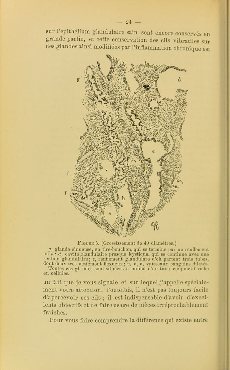 sur répithélium glandulaire sain sont encore conservés en grande partie, et cette conservation des cils vibratiles sur des glandes ainsi modifiées par l'inflammation chronique est FiGUKK 5. (Grossissemeut de 40 diamètres.) g, glande sinueuse, on tire-bouchon, qui se termine par uu renflement en h; d, cavité fîlandulaire presque kystiaue, qui se continue avec une section g'iandulaire ; e, renflement g-landulare d'où partent trois tubes, dont deux très nettement flexueux ; v, v, v, vaisseaux sanguins dilatés. Toutes ces glandes sont situées au milieu d'un tissu coujouctif ricbo en cellules. un fait que je vous signale et sur lequel j'appelle spéciale- ment votre attention. Toutefois, il n'est pas toujours facile d'apercevoir ces cils ; il est indispensable d'avoir d'excel- lents objectifs et de faire usage do pièces irroprocbablcmeut fraîches. Pour vous faire comprendre la différence qui existe entre