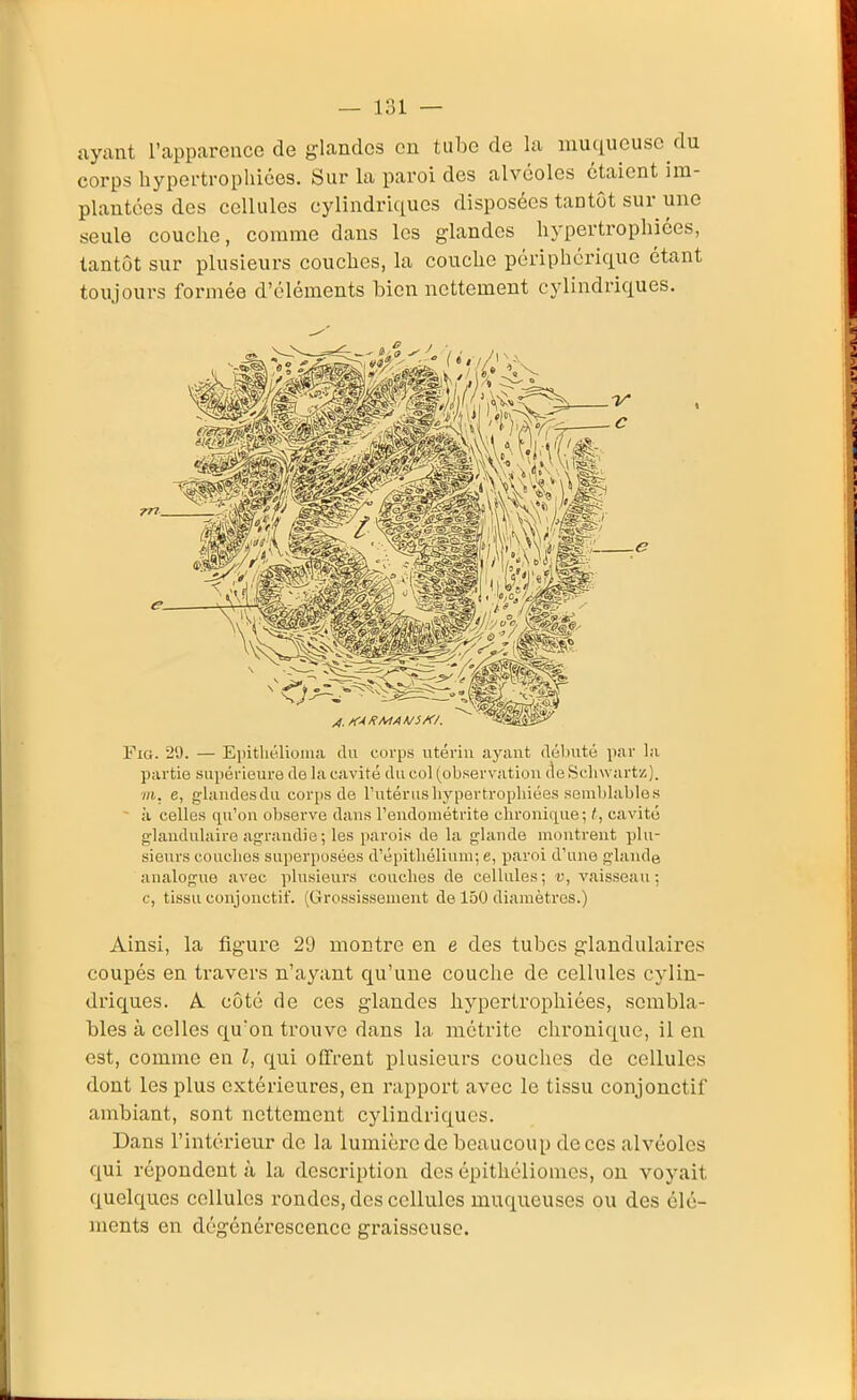 ayant l'apparence de glandes eu tube de la muqueuse du corps hypertropliiées. Sur la paroi des alvéoles étaient im- plantées des cellules cylindri(iues disposées tantôt sur une seule couche, comme dans les glandes hypertrophiées, tantôt sur plusieurs couches, la couche périphérique étant toujours formée d'éléments bien nettement cylindriques. FiG. 29. — E])itliélioiua du corps utérin ayant déluité par la partie supérieure de la cavité du col (observation de Scliwartz). m. e, glandesdu corps de l'utérushj'pertropliiées semblables - à celles qu'on observe dans l'eudométrite chronique; /, cavité glandulaire agrandie; les parois de la glande montrent plu- sieurs couches superposées d'épithélium; e, paroi d'une glande analogue avec plusieurs couches de cellules; v, vaisseau; c, tissu conjonctif. (Grossissement de 150 diamètres.) Ainsi, la figure 29 montre en e des tubes glandulaires coupés en travers n'ayant qu'une couche de cellules cylin- driques. A. côté de ces glandes hypertrophiées, sembla- bles à celles qu'on trouve dans la métrite chronique, il en est, comme en l, qui oCFrent plusieurs couches de cellules dont les plus extérieures, en rapport avec le tissu conjonctif ambiant, sont nettement cylindriques. Dans l'intérieur do la lumière de beaucoup de ces alvéoles qui répondent à la description des épithéliomes, ou voyait quelques cellules l'ondes, des cellules muqueuses ou des élé- ments en dégénérescence graisseuse.