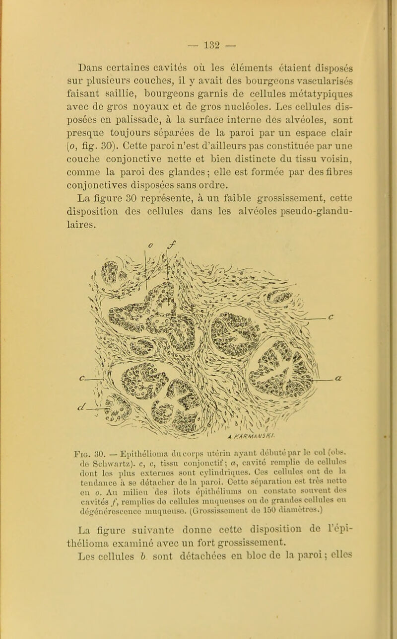Dans certaines cavités où les éléments étaient disposés sur i)lusicurs couches, il y avait des bourgeons vascularisés faisant saillie, bourgeons garnis de cellules anétatypiques avec de gros noyaux et de gros nucléoles. Les cellules dis- posées en palissade, à la surface interne des alvéoles, sont presque toujours sépai'ées de la paroi par un espace clair (o, fig. 30). Cette paroi n'est d'ailleurs pas constituée par une couche conjonctive nette et bien distincte du tissu voisin, comme la paroi des glandes -, elle est formée par des fibres conjonctives disposées sans ordre. La figure .30 représente, à un faible grossissement, cette disposition des cellules dans les alvéoles pseudo-glandu- laires. o y Fio. :iO. — Eiiitliélionia (lucoqis utùriii iiyaut ilclmté p.ir le col l'obs. (lo Seliwiirtz)- c, c, ti.s.su coujonctif; a, cavité roiiiiilio de cellules dont les i)lus externes sont cyliiulritiues. Ces cellules ont do la tendance à se détaclier de la paroi. Cette séparation est très notto on o. An milieu des ilôts éiiitliéliums on coustato souvent des cavités f, reniidies de cellules niuiinenses ou do «rrandes cellules ou défjéuérescenco inu(iuouso. (Grossissoniout do 150 diamètres.) La figure suivante donne cette disposition de l'épi- thclioma examiné avec un fort grossissement. Les cellules 6 sont détachées en bloc de la paroi ; elles