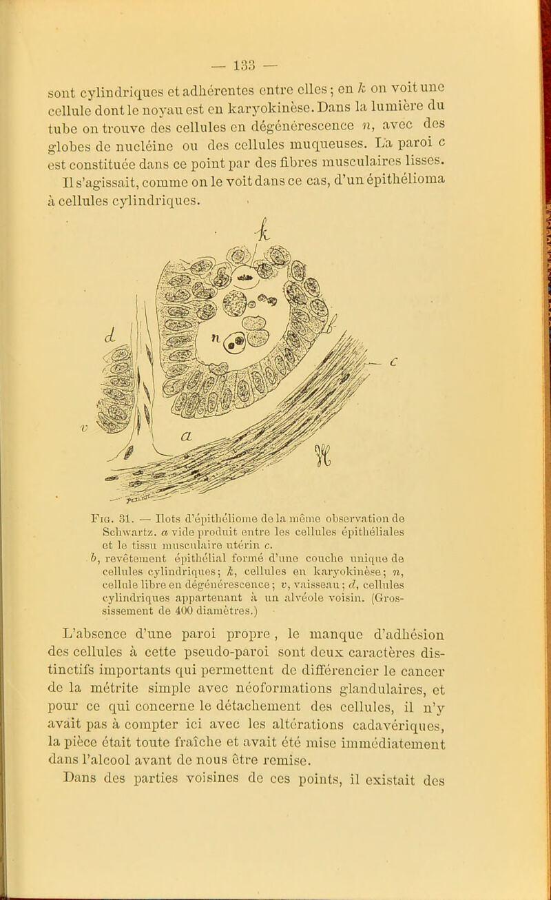 sont cylindriques et adhérentes entre elles; en k on voit une cellule dont le noyau est eu karyokinèse.Dans la lumière du tube on trouve des cellules en dégénérescence n, avec des globes de nucléine ou des cellules muqueuses. La paroi c est constituée dans ce point par des fibres musculaires lisses. Il s'agissait, comme on le voit dans ce cas, d'un épitliélioma à cellules cylindriques. Fio. 31. — Ilots d'épitliélioine delà môme observation do Sclnvartz. a vide produit entre les cellules épitliéliales et le tissu musculaire utérin c. b, revêtement épitliélial formé d'une couche unique de cellules cylindriques; /i, cellules en karyokinèse; n, cellule libre en dégénérescence; v, vaisseau; d, cellules cylindriques appartenant à un alvéole voisin. (Gros- sissement de 400 diamètres.) L'absence d'une paroi propre , le manque d'adhésion des cellules à cette pseudo-paroi sont deux caractères dis- tinctifs importants qui permettent de différencier le cancer de la métrite simple avec néoformations glandulaires, et pour ce qui concerne le détachement des cellules, il n'y avait pas à compter ici avec les altérations cadavériques, la pièce était toute fraîche et avait été mise immédiatement dans l'alcool avant de nous être remise. Dans des parties voisines de ces points, il existait des