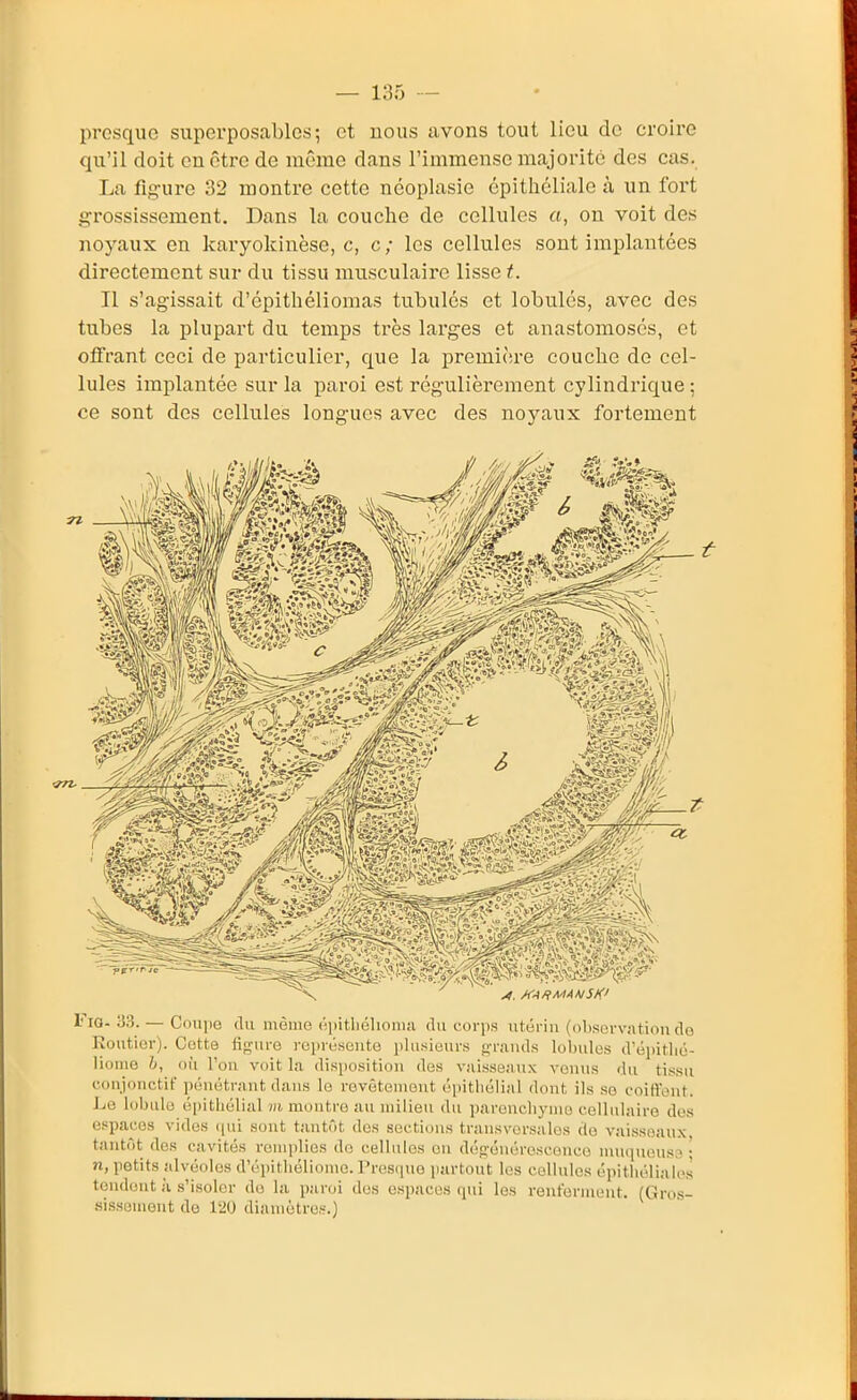 presque supei'posables ; et nous avons tout lieu de croire qu'il doit en être de même dans l'immense majorité des cas. La fig-ure 32 montre cette néoplasie cpitliéliale à un fort grossissement. Dans la couche de cellules a, on voit des noyaux en karyokinèse, c, c ; les cellules sont implantées directement sur du tissu musculaire lisse t. Il s'agissait d'épithéliomas tubulés et lobules, avec des tubes la plupart du temps très larges et anastomosés, et oïFrant ceci de particulier, que la première couche de cel- lules implantée sur la paroi est régulièrement cylindrique : ce sont des cellules longues avec des noyaux fortement FlG- 33. — Couiie du même ('pitliélioma du corps utérin (observation do Eoutior). Cette iii>'ure représente plusieurs f>-rnuds lobules d'épitlié- lioine h, où Fou voit la disposition des vaisseaux venus du tissu coujouctif pénétrant dans le revêtement épitliélial dont ils se coiffent. Le lobule épitliélial vi montre au milieu du parencliyuio cellulaire dos espaces vides (jui sont tantôt des sections transversales do vaissoaux tantôt des cavités remplies do cellules en dé^'énérosconco muquous,^ • n, petits alvéoles d'épitliéliome. l'restpio partout les cellules épitliélialos tendent à .s'isoler do la paroi des espaces qui les renferment. (Gro.s- .sissument de 120 diamètres.)
