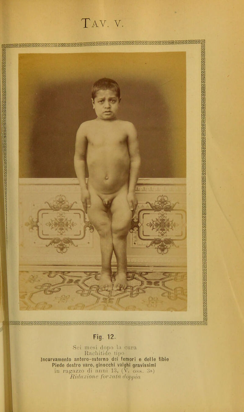 ljtj]fiJ[f| p](/)fiJ[fi'jStfifd[fipJtj]pj[j1fillqr^[j]fDGT^ Fig. 12. Si'i nii!si (lopiì 1:> «Mira RiiL'liitido liiiii Incurvamento antero-csterno dei femori o delle fibio Piede destro varo, ginocchi valghi gravissimi in r:ii;;i/./() di mini (V. os.s. .U) Rulli,-inni' fiir -fitn iloppìa.