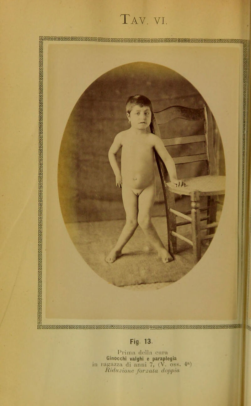 P I Fig. 13. I'i-im;i cm-.'i Ginocchi valghi e paraplegia in i;i,ì;ìi//!i di unni 7, (V. oss. i>^) Rifili.rioni- Jor^a/a ii<ìppiii
