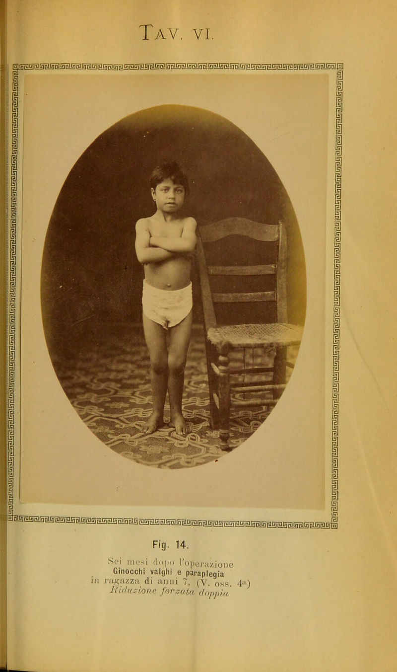 r i I I I g g g g 151 i 1 fa ,l] LSI raj I 1^ > Fig H. Sci mesi r(t|)ci'a/ioiie Ginocchi valghi e paraplegia ili l'ugnzzii di anni 7, (V. oss. 4) Jiù/u^ione forzata doppin