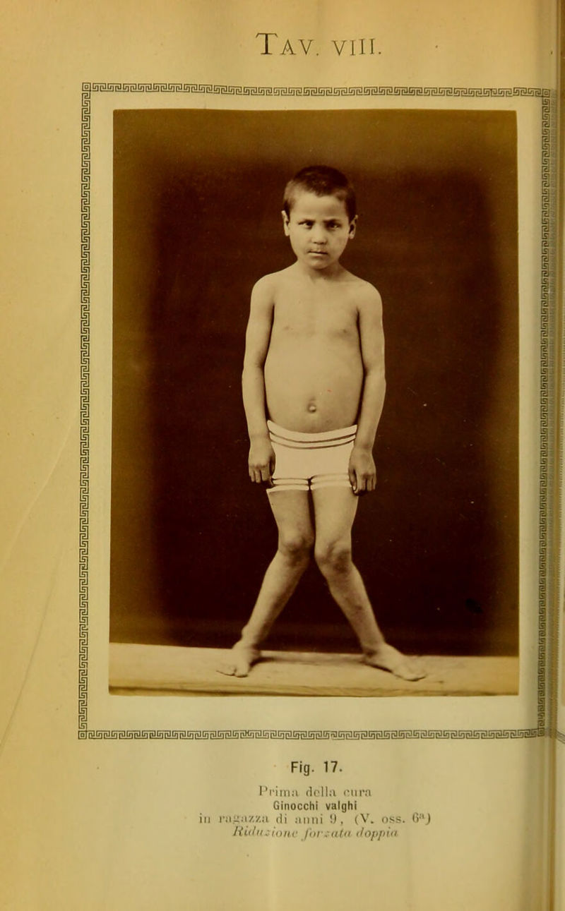 l'iliui (Irll.i iMiivi Ginocchi valghi in r.iiiii/.za di ;iiini 5), (V. oss. 6J Riiln