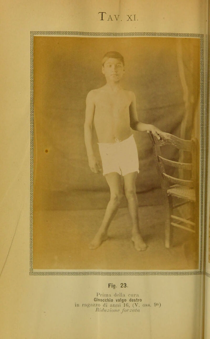 i I il Fig. 23. l'iilllM (li'U.l riii'.i Ginocchio valgo destro ili r:iir:i/./.o Hi .•nini Kì, (V. oss. 9») liìilil :inin' /nr.'ittti