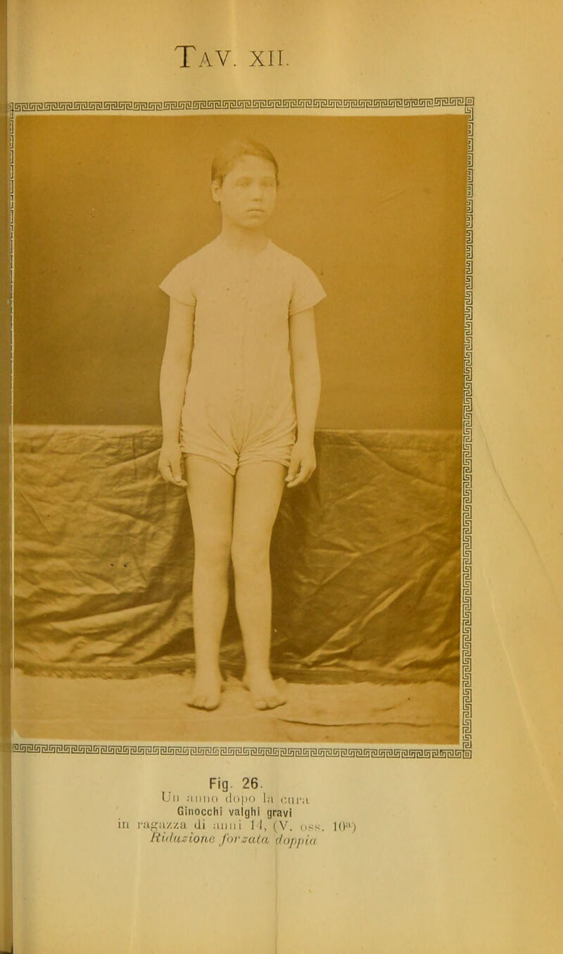 Fig. 26. Un .•inno dopo la <;ihm Ginocchi valghi gravi in i'ai,^a/,/,a di anni 11, (V. nss. KI'O Rit(i.i;rione forcata c/oppia