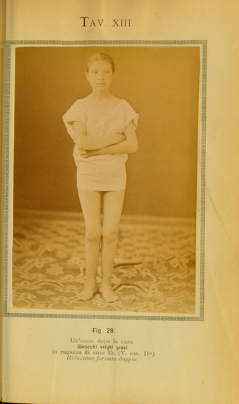 llii'aiiiio la ciii'M Ginocchi valghi gravi in rugiiz/.a di anni 15, (V. oss. Riduzione Jov^aUi (/<>/ifii(/