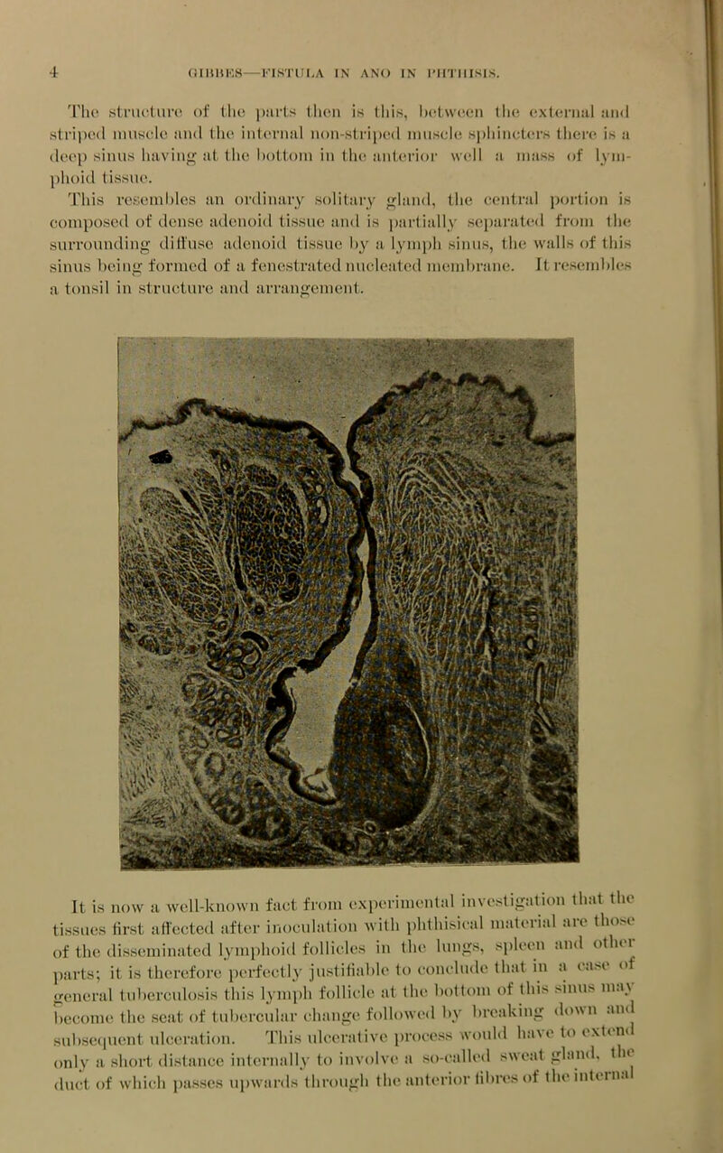 The stnictnro of the piirts then is this, between the external jukI sti'i]ic(l muscle iuul the internal non-striped muscle sphincters there is a deep sinus having at the bottom in the anterior well a mass of lym- phoid tissue. This resembles an ordinary solitary gland, the central portion is composed of dense adenoid tissue and is partially separated from the suiTOunding dithise adenoid tissue by a lymph sinus, the walls of this sinus being formed of a fenestrated nucleated membrane. It resembles a tonsil in structure and arrangement. Piii It is now a well-known fact from experimental investigation that the tissues first affected after inoculation with phthisical material are those of the disseminated lymphoid follicles in the lungs, spleen and other parts; it is therefore perfectly justilial)le to conclude that in a case of general tuberculosis this lymph follicle at the bottom of this sinus may l,ecome the seat of tubercular change followed by breaking down and subsequent ulceration. This ulcerative process would have to extend only a short distance internally to involve a so-called sweat gland, tho duct of which passes upwards through the anterior fibres of the internal