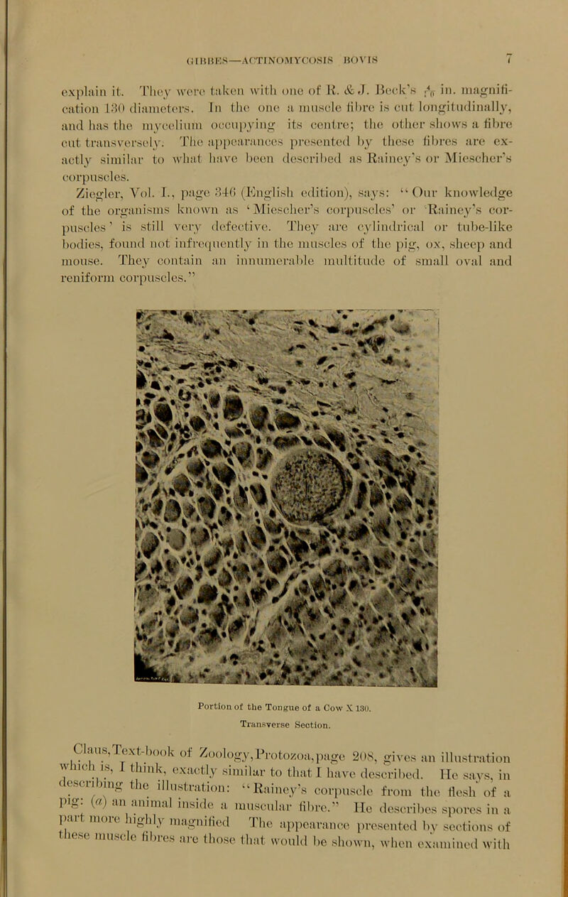 (iLHHKS—ACTINOMYCO.SIS H<)\'rs ( explain it. They wero taken with one of K. & J. Beck''K r,, in. magnifi- cation 130 diameters. In tlie one a miisele tilire is cut longitudinally', and has the mycelium occupying its centres; the other shows a fibre cut transversely. The appearances presented by these libres are ex- actly simihir to what have been described as Rainey's or Miescher's corpuscles. Ziegler, Vol. I., psige 346 (English edition), says: Our knowledge of the organisms known as 'Miescher's corpuscles' or Rainey's cor- puscles ' is still very defective. They are cylindrical or tube-like l)odies, found not infrcepiently in the muscles of the pig, ox, sheep and mouse. They contain an innumerable multitude of small oval and reniform corpuscles. .... Portion of the Tongue of a Cow X l3o. Transverse Section. Claus,Text-book of Zoology,Protozoa,page 208, gives an illustration which IS, 1 thmk, exactly similar to that I have described. He says, in describmg the illustration: Rainey's corpuscle from the flesh of a pig: {a) an animal inside a muscular fibre. He describes spores in a part more highly magnified The appearance presented by sections of these muscle fibres are those that would be shown, when examined wifh