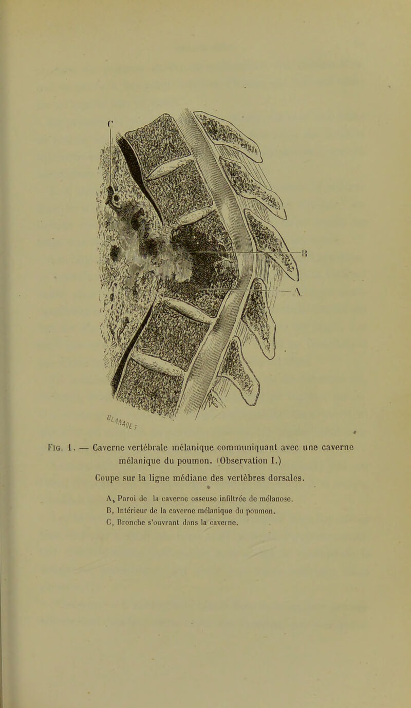 FiG. 1. — Caverne vertébrale inclanique communiquant avec une caverne mélanique du poumon. 'Observation I.) Coupe sur la ligne médiane des vertèbres dorsales. * A, Paroi de la caverne osseuse infiltrée de mclanose. B, Intérieur de la caverne mélanique du poumon. C, Bronche s'ouvrant dans la caverne.