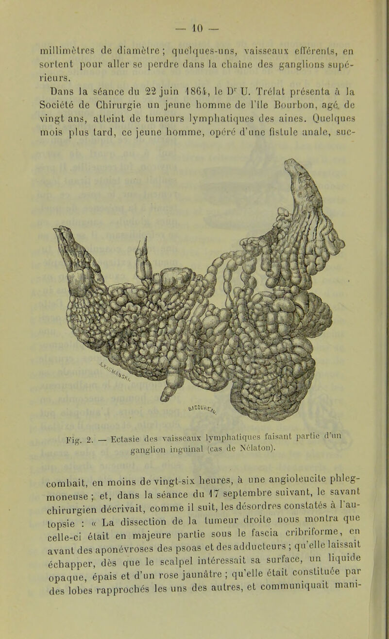 millimèlrcs de diamclre; quelques-uns, vaisseaux efï'érenls, en sortent pour aller se perdre dans la chaîne des ganglions supé- rieurs. Dans Ja séance du 22 juin 186i, le D U, Trélat présenta à la Société de Chirurgie un jeune homme de l'ile Bourbon, âgé. de vingt ans, atteint de tumeurs lymphatiques des aines. Quelques mois plus tard, ce jeune homme, opéré d'une fistule anale, suc- Fig. 2. — Ectasie des vaisseaux lymphatiques faisant paiiie d'un ganglion inguinal (cas de Nélatou). combait, en moins de vingt-six heures, h une angioleucite phleg- moneuse; et, dans la séance du 17 septembre suivant, le savant chirurgien décrivait, comme il suit, les désordres constatés à lau- topsie : « La dissection de la tumeur droite nous montra que celle-ci était en majeure partie sous le fascia cribriforme, en avant des aponévroses des psoas et des adducteurs ; qu'elle laissait échapper, dès que le scalpel intéressait sa surface, un liquide opaque, épais et d'un rose jaunâtre ; qu'elle était constituée par des lobes rapprochés les uns des autres, et communiquait mani-