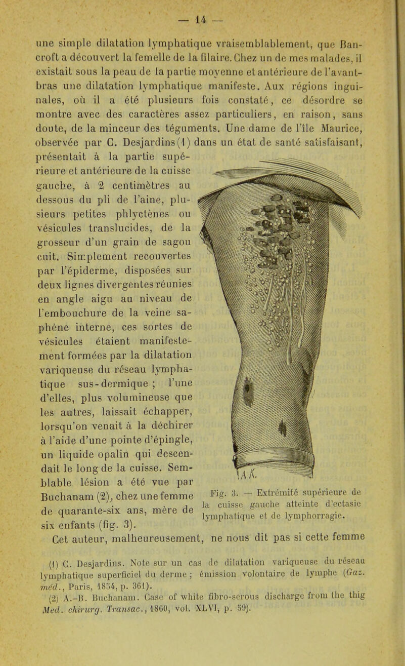 une simple dilatation lymphatique vraisemblablement, que Ban- croft a découvert la femelle de la Pilaire. Chez un de mes malades, il existait sous la peau de la partie moyenne et antérieure del'avant- bras une dilatation lymphatique manifeste. Aux régions ingui- nales, où il a été plusieurs fois constaté, ce désordre se montre avec des caractères assez particuliers, en raison, sans doute, de la minceur des téguments. Une dame de l'île Maurice, observée par C. Desjardins(1) dans un état de santé satisfaisant, présentait à la partie supé- rieure et antérieure de la cuisse gauche, à 2 centimètres au dessous du pli de l'aine, plu- sieurs petites phlyctènes ou vésicules translucides, de la grosseur d'un grain de sagou cuit. Simplement recouvertes par l'épiderme, disposées sur deux lignes divergentes réunies en angle aigu au niveau de l'embouchure de la veine sa- phène interne, ces sortes de vésicules étaient manifeste- ment formées par la dilatation variqueuse du réseau lympha- tique sus-dermique ; l'une d'elles, plus volumineuse que les autres, laissait échapper, lorsqu'on venait à la déchirer à l'aide d'une pointe d'épingle, un liquide opalin qui descen- dait le long de la cuisse. Sem- blable lésion a été vue par Buchanam (2);, chez une femme de quarante-six ans, mère de six enfants (fig. 3). Cet auteur, malheureusement, ne nous dit pas si cette femme Fig. 3. — Extrémité supérieure de la cuisse gauche atteinte d'ectasie lymphatique et de lymphorragie. (1) G. Desjardius. Note sur un cas de diUitatiou vaiiqiicnse du réseau lymphatique superficiel du derme ; émission volontaire de lymphe {Gaz. méd., Paris, 18154, p. 361). (2) A.-B. Buchanam. Case of white fihro-sorous discharge from thc Ihig Med. chiricrg. Trausac., ISm, vol. XLVl, p. 59).