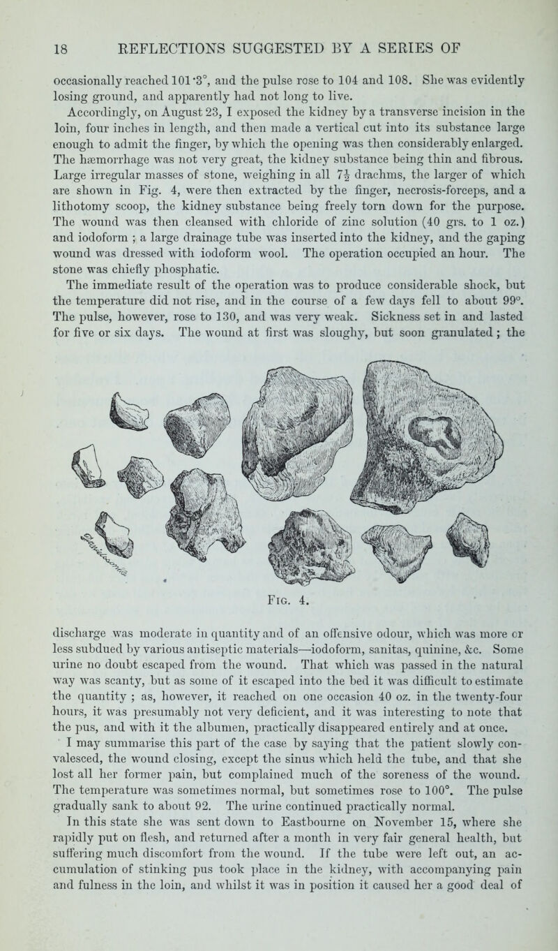 occasionally reached 101 *3°, and the pulse rose to 104 and 108. She was evidently losing ground, and apparently had not long to live. Accordingly, on August 23, I exposed the kidney by a transverse incision in the loin, four inches in length, and then made a vertical cut into its substance large enough to admit the finger, by which the opening was then considerably enlarged. The haemorrhage was not very great, the kidney substance being thin and fibrous. Large irregular masses of stone, weighing in all 7J drachms, the larger of which are shown in Fig. 4, were then extracted by the finger, necrosis-forceps, and a litbotomy scoop, the kidney substance being freely torn down for the purpose. The wound was then cleansed with chloride of zinc solution (40 grs. to 1 oz.) and iodoform ; a large drainage tube was inserted into the kidney, and the gaping wound was dressed with iodoform wool. The operation occupied an hour. The stone was chiefly phosphatic. The immediate result of the operation was to produce considerable shock, but the temperature did not rise, and in the course of a few days fell to about 99°. The pulse, however, rose to 130, and was very weak. Sickness set in and lasted for five or six days. The wound at first was sloughy, but soon granulated ; the Fig. 4. discharge was moderate in quantity and of an offensive odour, which was more or less subdued by various antiseptic materials—iodoform, sanitas, quinine, &c. Some urine no doubt escaped from the wound. That which was passed in the natural way was scanty, but as some of it escaped into the bed it was difficult to estimate the quantity ; as, however, it reached on one occasion 40 oz. in the twenty-four hours, it was presumably not very deficient, and it was interesting to note that the pus, and with it the albumen, practically disappeared entirely and at once. I may summarise this part of the case by saying that the patient slowly con- valesced, the wound closing, except the sinus which held the tube, and that she lost all her former pain, but complained much of the soreness of the wound. The temperature was sometimes normal, but sometimes rose to 100°. The pulse gradually sank to about 92. The urine continued practically normal. In this state she was sent down to Eastbourne on November 15, where she rapidly put on flesh, and returned after a month in very fair general health, but suffering much discomfort from the wound. If the tube were left out, an ac- cumulation of stinking pus took place in the kidney, with accompanying pain and fulness in the loin, and whilst it was in position it caused her a good deal of