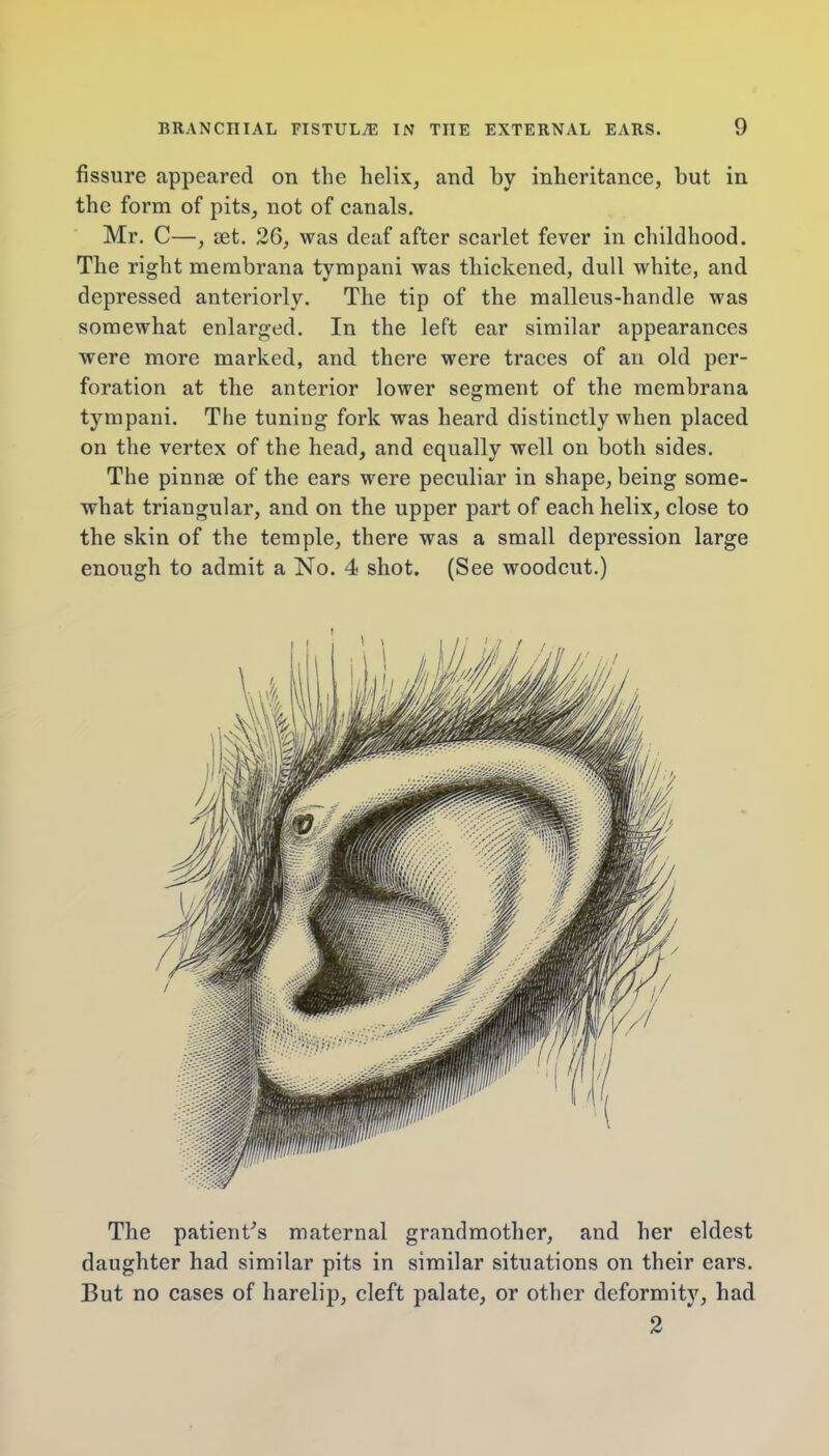 fissure appeared on the helix, and by inheritance, but in the form of pits, not of canals. Mr. C—, set. 26, was deaf after scarlet fever in childhood. The right membrana tympani was thickened, dull white, and depressed anteriorly. The tip of the malleus-handle was somewhat enlarged. In the left ear similar appearances were more marked, and there were traces of an old per- foration at the anterior lower segment of the membrana tympani. The tuning fork was heard distinctly when placed on the vertex of the head, and equally well on both sides. The pinnae of the ears were peculiar in shape, being some- what triangular, and on the upper part of each helix, close to the skin of the temple, there was a small depression large enough to admit a No. 4 shot. (See woodcut.) The patient's maternal grandmother, and her eldest daughter had similar pits in similar situations on their ears. But no cases of harelip, cleft palate, or other deformity, had 2