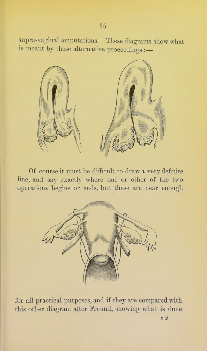 supra-vaginal amputations. These diagrams show what is meant by these alternative proceedings :— Of course it must be difficult to draw a very definite line, and say exactly where one or other of the two operations begins or ends, but these are near enough for all practical purposes, and if they are compared with this other diagram after Freund, showing what is done c 2