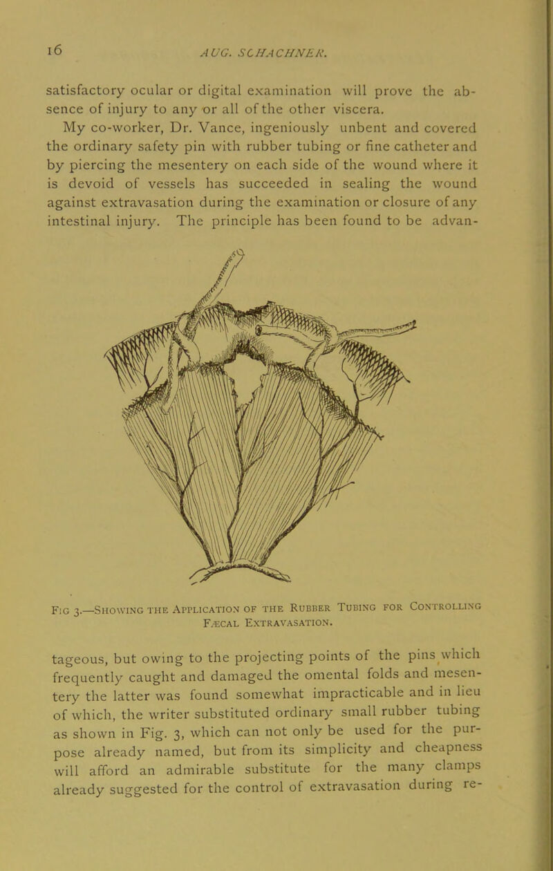 satisfactory ocular or digital examination will prove the ab- sence of injury to any or all of the other viscera. My co-worker, Dr. Vance, ingeniously unbent and covered the ordinary safety pin with rubber tubing or fine catheter and by piercing the mesentery on each side of the wound where it is devoid of vessels has succeeded in sealing the wound against extravasation during the examination or closure of any intestinal injury. The principle has been found to be advan- Fig 3.—Showing the Application of the Rubber Tubing for Controlling F/ECal Extravasation. tageous, but owing to the projecting points of the pins which frequently caught and damaged the omental folds and mesen- tery the latter was found somewhat impracticable and in lieu of which, the writer substituted ordinary small rubber tubing as shown in Fig. 3, which can not only be used for the pur- pose already named, but from its simplicity and cheapness will afford an admirable substitute for the many clamps already suggested for the control of extravasation during re-