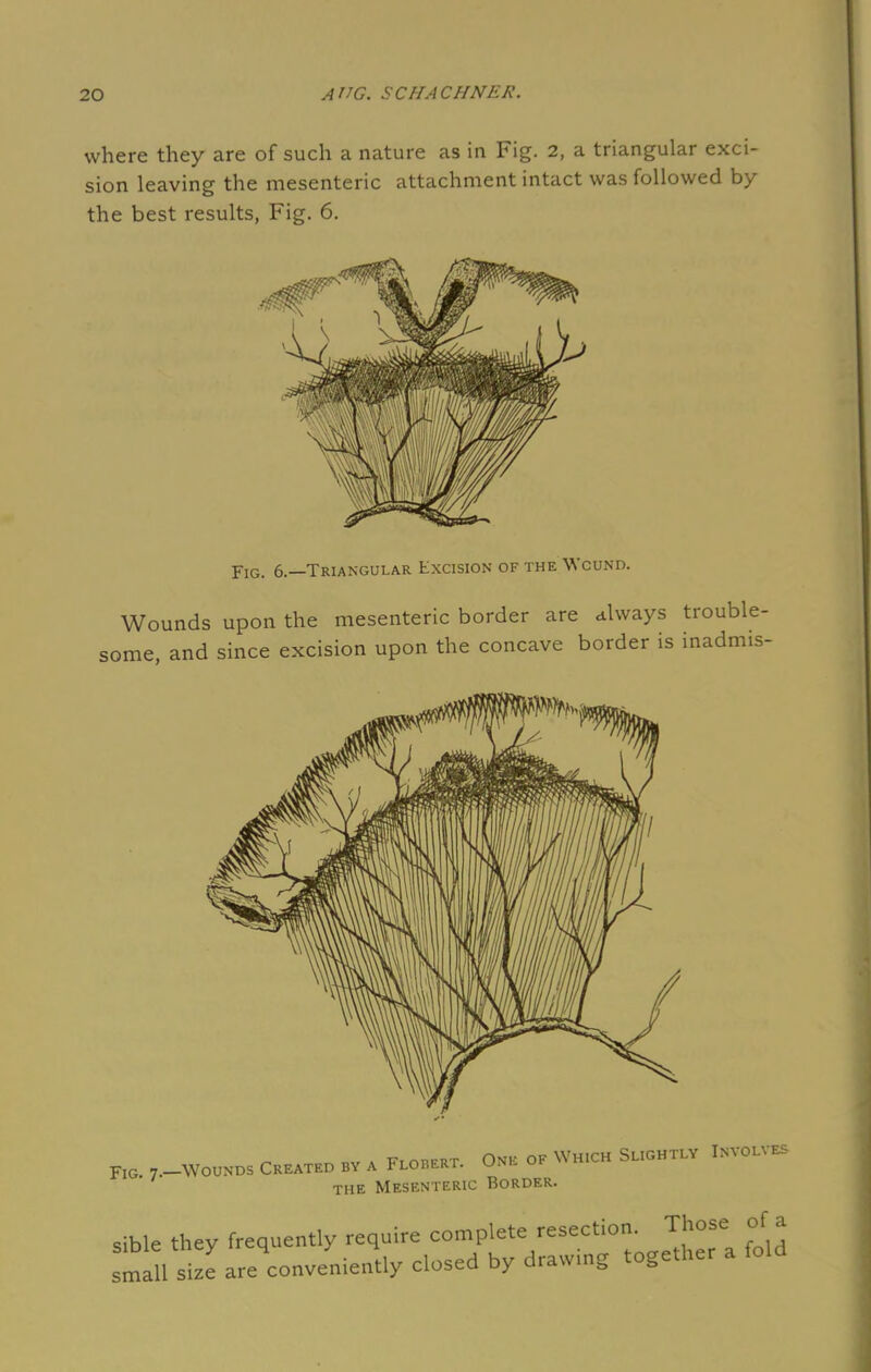 where they are of such a nature as in Fig. 2, a triangular exci- sion leaving the mesenteric attachment intact was followed by the best results, Fig. 6. Fig. 6.—Triangular Excision of the Wound. Wounds upon the mesenteric border are always trouble- some, and since excision upon the concave border is inadmis- Fig 7.-Wounos Created bv a Flobert. One ok Which Slights Involves the Mesenteric Border. sible they frequently require complete resection. Those of a !mall size are conveniently closed by drawing together a fold