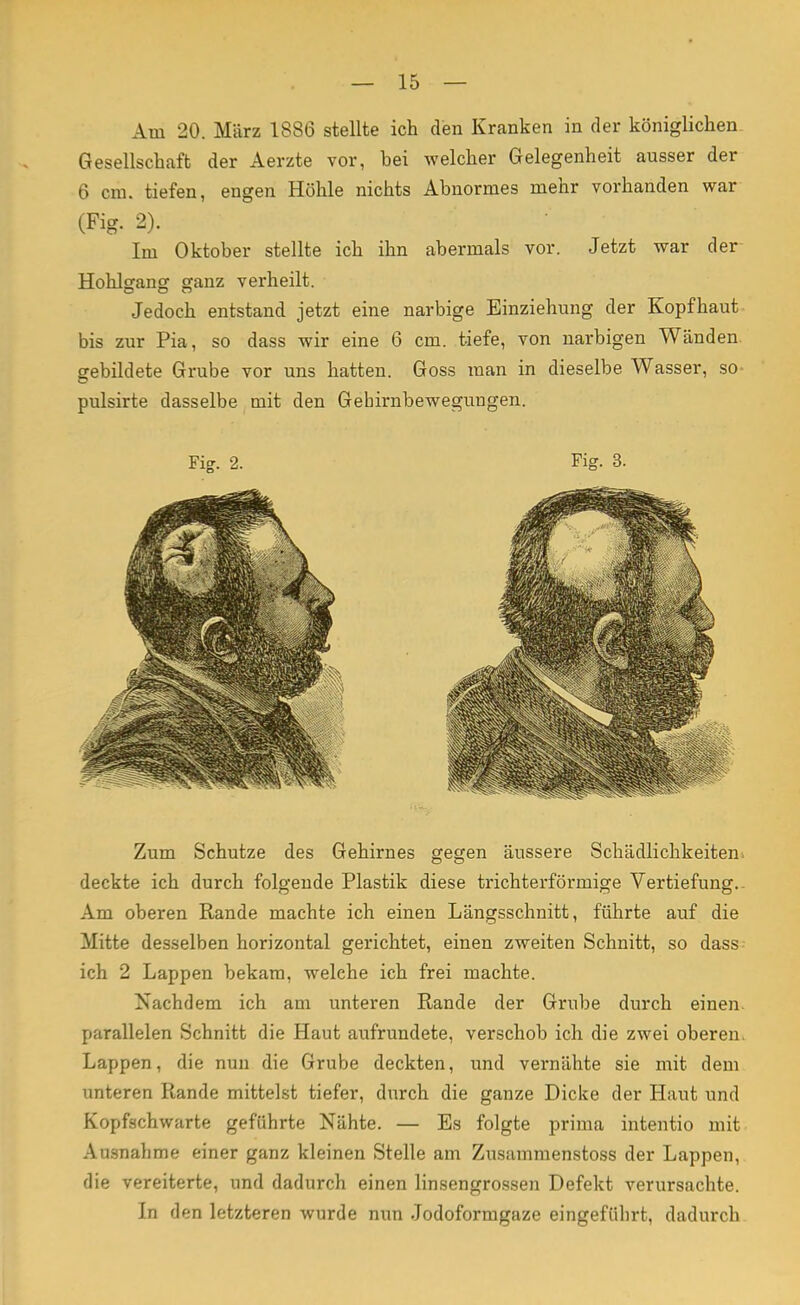 Am 20. März 1886 stellte ich den Kranken in der königlichen Gesellschaft der Aerzte vor, bei welcher Gelegenheit ausser der 6 cm. tiefen, engen Höhle nichts Abnormes mehr vorhanden war (Fig. 2). Im Oktober stellte ich ihn abermals vor. Jetzt war der Hohlgang ganz verheilt. Jedoch entstand jetzt eine narbige Einziehung der Kopfhaut bis zur Pia, so dass wir eine 6 cm. tiefe, von narbigen Wänden gebildete Grube vor uns hatten. Goss man in dieselbe Wasser, so pulsirte dasselbe mit den Gehirnbewegungen. Zum Schutze des Gehirnes gegen äussere Schädlichkeiten* deckte ich durch folgende Plastik diese trichterförmige Vertiefung. - Am oberen Rande machte ich einen Längsschnitt, führte auf die Mitte desselben horizontal gerichtet, einen zweiten Schnitt, so dass ich 2 Lappen bekam, welehe ich frei machte. Nachdem ich am unteren Rande der Grube durch einen, parallelen Schnitt die Haut aufrundete, verschob ich die zwei oberen. Lappen, die nun die Grube deckten, und vernähte sie mit dem unteren Rande mittelst tiefer, durch die ganze Dicke der Haut und Kopfschwarte geführte Nähte. — Es folgte prima intentio mit Ausnahme einer ganz kleinen Stelle am Zusammenstoss der Lappen, die vereiterte, und dadurch einen linsengrossen Defekt verursachte. In den letzteren wurde min Jodoformgaze eingeführt, dadurch