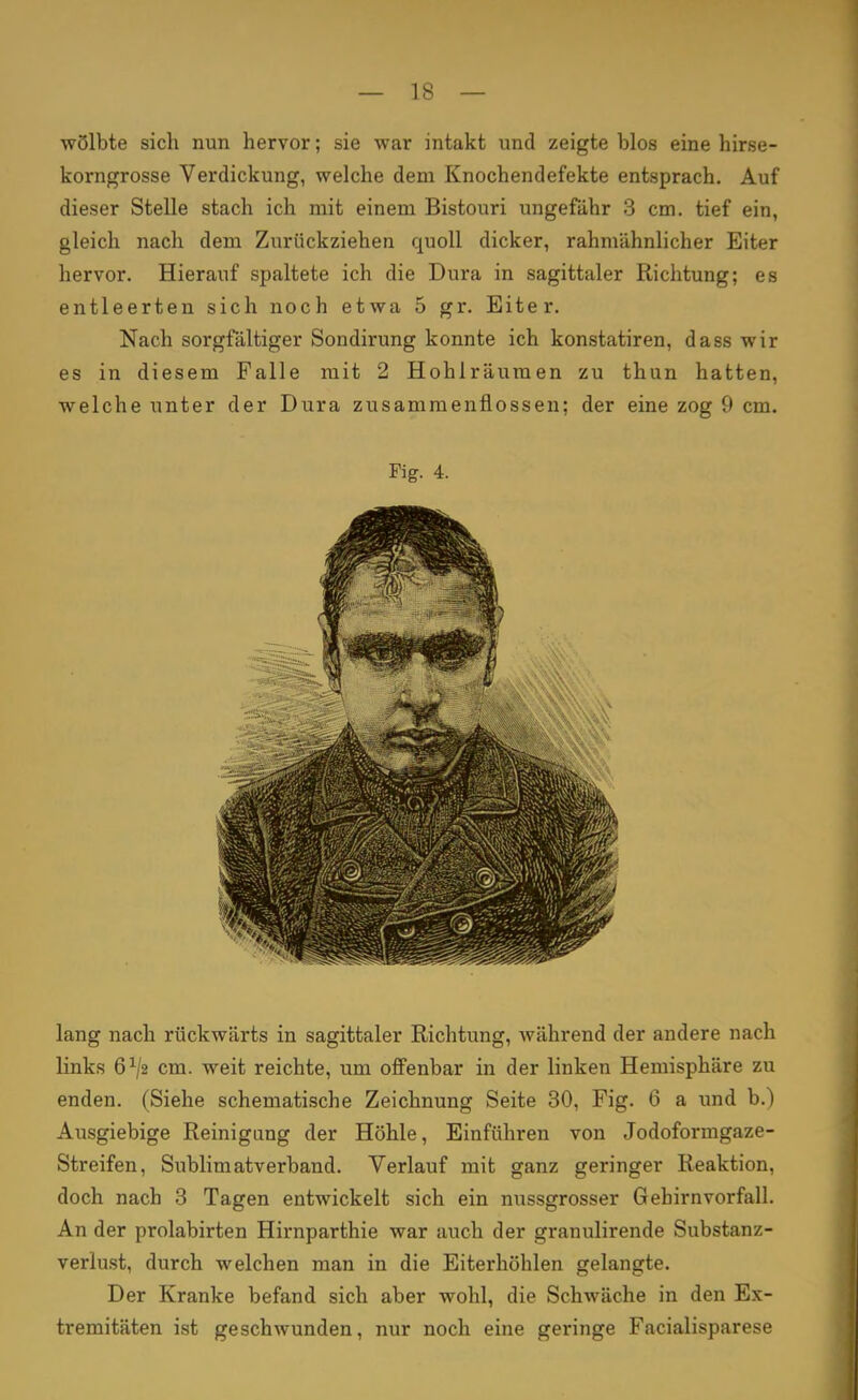 wölbte sich nun hervor; sie war intakt und zeigte blos eine hirse- korngrosse Verdickung, welche dem Knochendefekte entsprach. Auf dieser Stelle stach ich mit einem Bistouri ungefähr 3 cm. tief ein, gleich nach dem Zurückziehen quoll dicker, rahmähnlicher Eiter hervor. Hierauf spaltete ich die Dura in sagittaler Richtung; es entleerten sich noch etwa 5 gr. Eiter. Nach sorgfältiger Sondirung konnte ich konstatiren, dass wir es in diesem Falle mit 2 Hohlräumen zu thun hatten, welche unter der Dura zusammenflössen; der eine zog 9 cm. Fig. 4. lang nach rückwärts in sagittaler Richtung, während der andere nach links 6x/2 cm. weit reichte, um offenbar in der linken Hemisphäre zu enden. (Siehe schematische Zeichnung Seite 30, Fig. 6 a und b.) Ausgiebige Reinigung der Höhle, Einführen von Jodoformgaze- Streifen, Sublimatverband. Verlauf mit ganz geringer Reaktion, doch nach 3 Tagen entwickelt sich ein nussgrosser Gehirnvorfall. An der prolabirten Hirnparthie war auch der granulirende Substanz- verlust, durch welchen man in die Eiterhöhlen gelangte. Der Kranke befand sich aber wohl, die Schwäche in den Ex- tremitäten ist geschwunden, nur noch eine geringe Fazialisparese