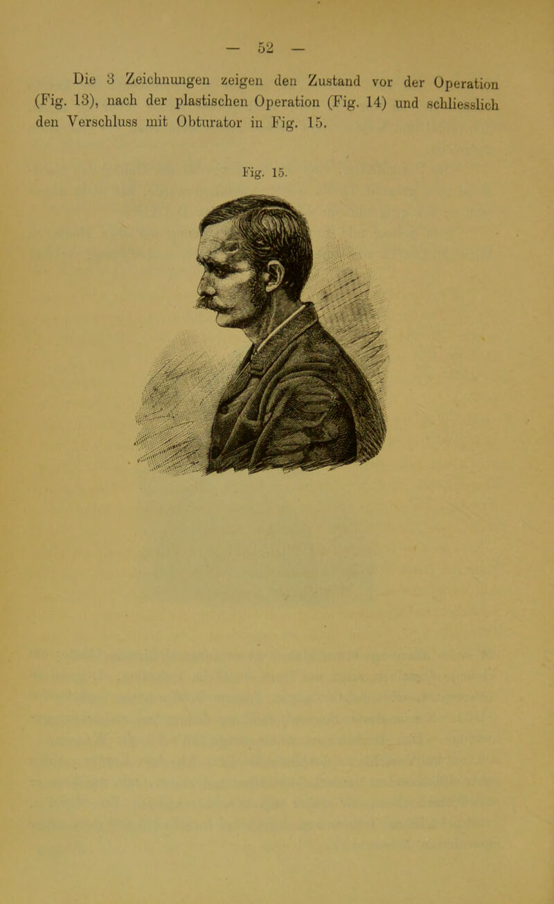 Die 3 Zeichnungen zeigen den Zustand vor der Operation (Fig. 13), nach der plastischen Operation (Fig. 14) und schliesslich den Verschluss mit Obturator in Fig. 15. Fig. 15.