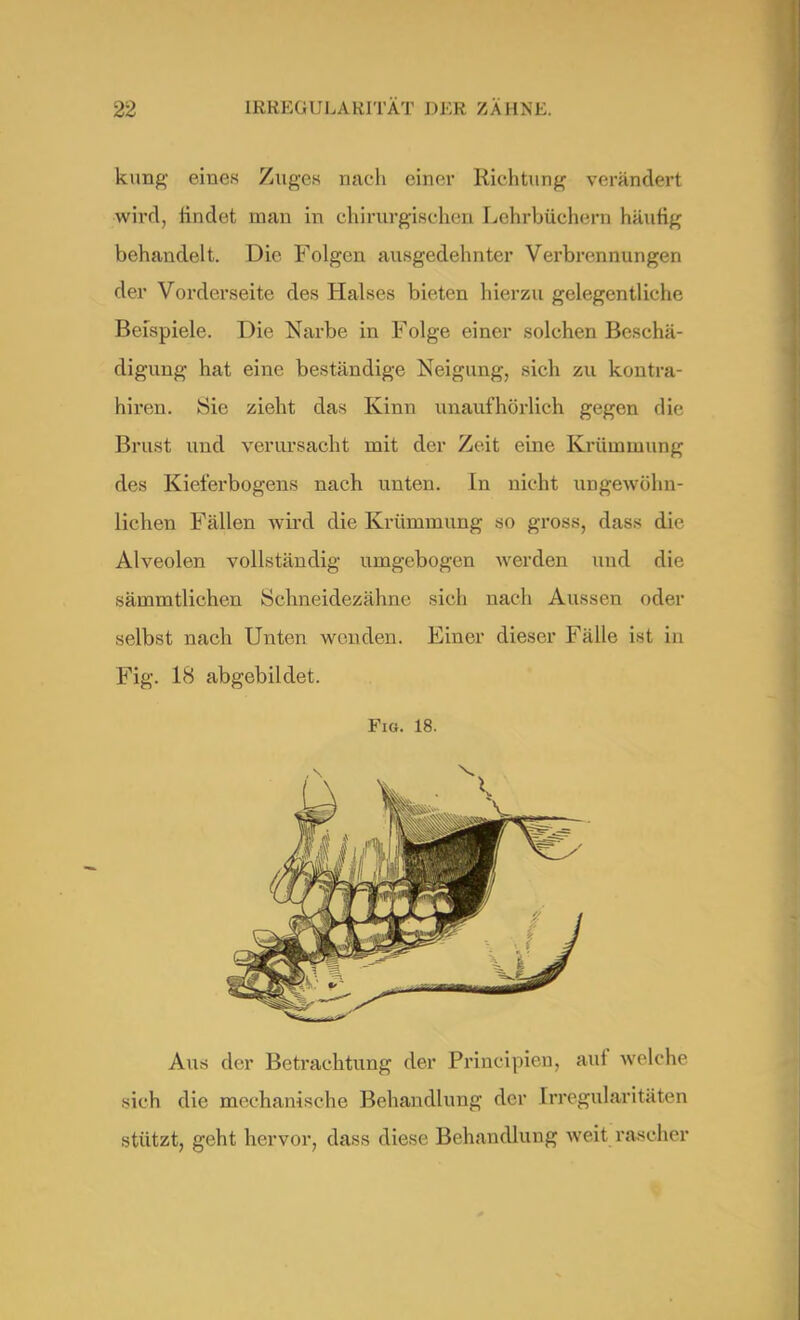 kung- eines Zuges nach einer Richtung verändert wird, rindet man in chirurgischen Lehrbüchern häufig behandelt. Die Folgen ausgedehnter Verbrennungen der Vorderseite des Halses bieten hierzu gelegentliche Beispiele. Die Narbe in Folge einer solchen Beschä- digung hat eine beständige Neigung, sich zu kontra- hiren. Sie zieht das Kinn unaufhörlich gegen die Brust und verursacht mit der Zeit eine Krümmung des Kielerbogens nach unten. In nicht ungewöhn- lichen Fällen wird die Krümmung so gross, dass die Alveolen vollständig umgebogen werden und die sämmtlichen Schneidezähne sich nach Aussen oder selbst nach Unten wenden. Einer dieser Fälle ist in Fig. 18 abgebildet. Fig. 18. Aus der Betrachtung der Principien, auf welche sich die mechanische Behandlung der [rregularitäten stützt, geht hervor, dass diese Behandlung weit rascher