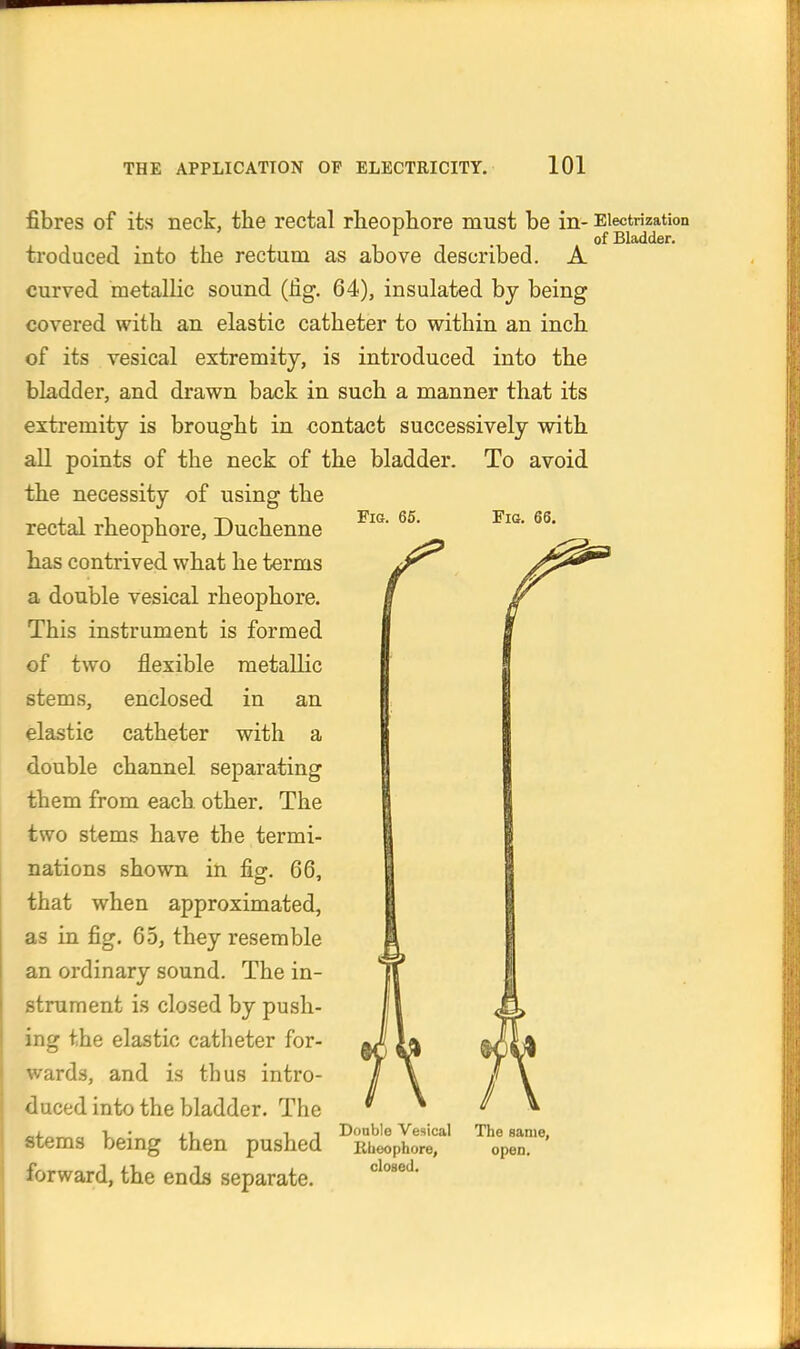 Fig. 65. Fig. 66. r fibres of its neck, the rectal rlieophore must be in- Electrization ^ of Bladder. troduced into the rectum as above described. A curved metallic sound (Jig. 64), insulated by being covered with an elastic catheter to within an inch of its vesical extremity, is introduced into the bladder, and drawn back in such a manner that its extremity is brought in contact successively with all points of the neck of the bladder. To avoid the necessity of using the rectal rheophore, Duchenne has contrived what he terms a double vesical rheophore. This instrument is formed of two flexible metallic stems, enclosed in an elastic catheter with a double channel separating them from each other. The two stems have the termi- nations shown in fig. 66, that when approximated, as in fig. 65, they resemble an ordinary sound. The in- strument is closed by push- ing the elastic catheter for- wards, and is thus intro- duced into the bladder. The stems being then pushed forward, the ends separate. Double Vesical Rbeophore, closed. The flame, open.