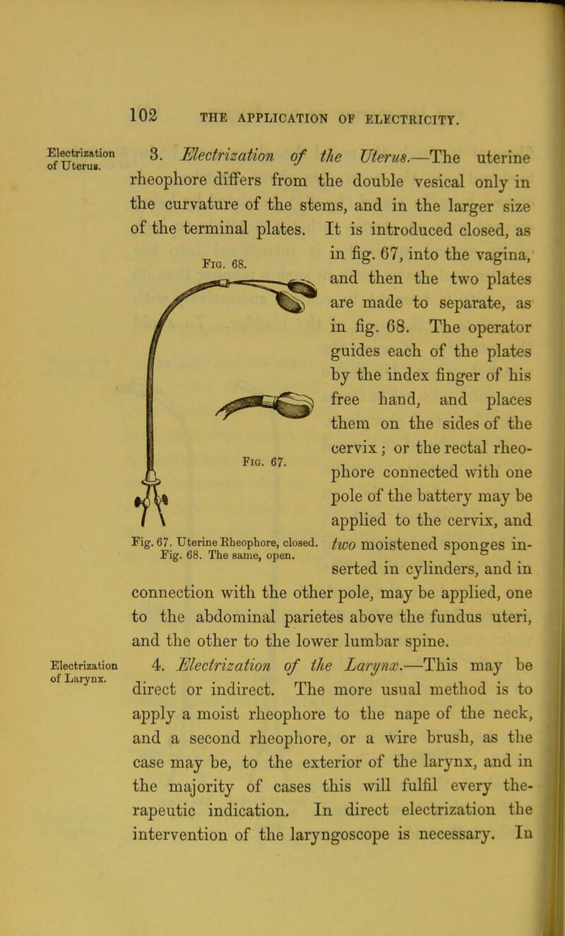 Electrization of UteruB. Electrization of Larynx. 3. Electrization of the Uterus.—The uterine rheophore differs from the double vesical only in the curvature of the stems, and in the larger size of the terminal plates. It is introduced closed, as in fig. 67, into the vagina, and then the two plates are made to separate, as Fig. 68. Fig. 67. Fig. 67. Uterine Eheophore, closed. Fig. 68. The same, open. in fig. 68. The operator guides each of the plates by the index finger of his free hand, and places them on the sides of the cervix; or the rectal rheo- phore connected with one pole of the battery may be applied to the cervix, and two moistened sponges in- serted in cylinders, and in connection with the other pole, may be applied, one to the abdominal parietes above the fundus uteri, and the other to the lower lumbar spine. 4. Electrization of the Larynx.—This may be direct or indirect. The more usual method is to apply a moist rheophore to the nape of the neck, and a second rheophore, or a wire brush, as the case may be, to the exterior of the larynx, and in the majority of cases this will fulfil every the- rapeutic indication. In direct electrization the intervention of the laryngoscope is necessary. In