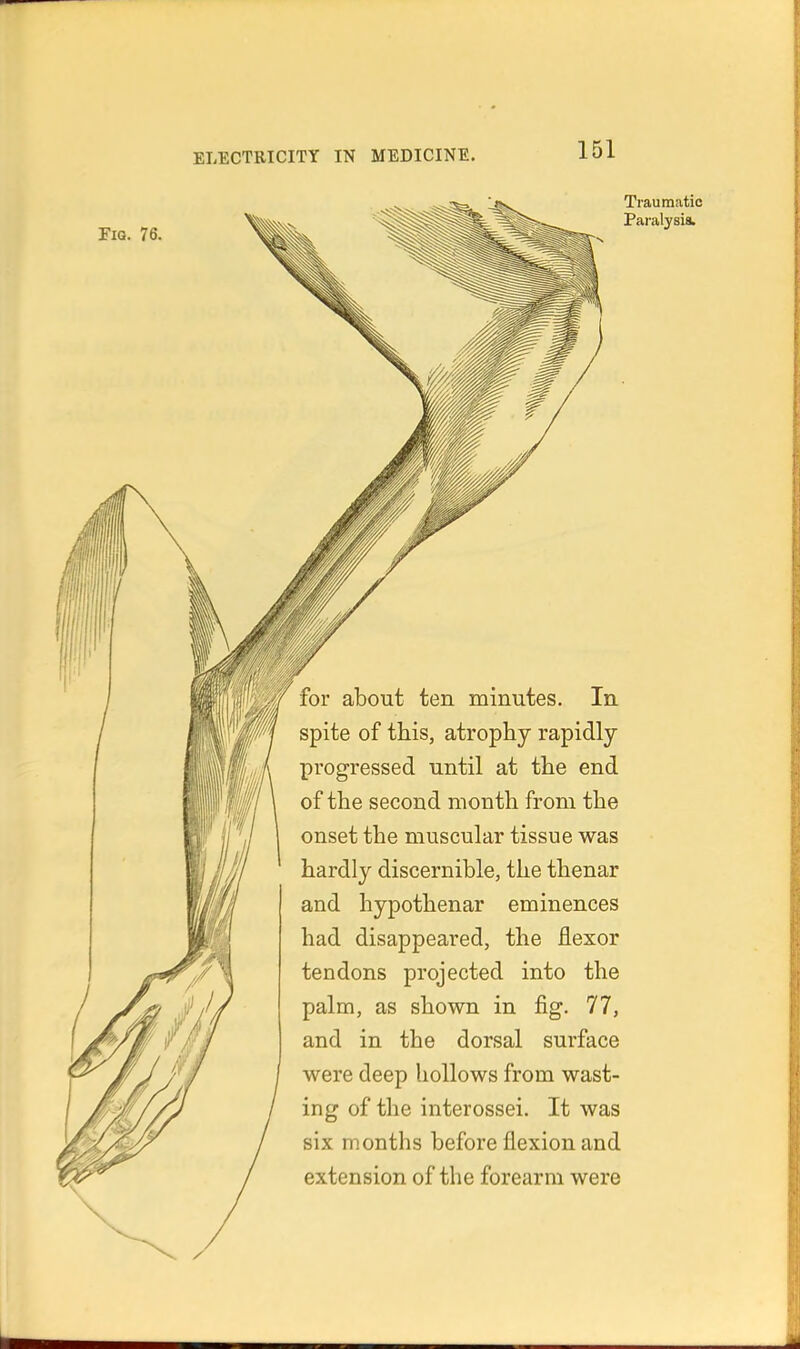 Fig. 76. Traumatic Paralysis. for about ten minutes. In spite of this, atrophy rapidly progressed until at the end of the second month from the onset the muscular tissue was hardly discernible, the thenar and hypothenar eminences had disappeared, the flexor tendons projected into the palm, as shown in fig. 77, and in the dorsal surface were deep hollows from wast- ing of the interossei. It was six months before flexion and extension of the forearm were