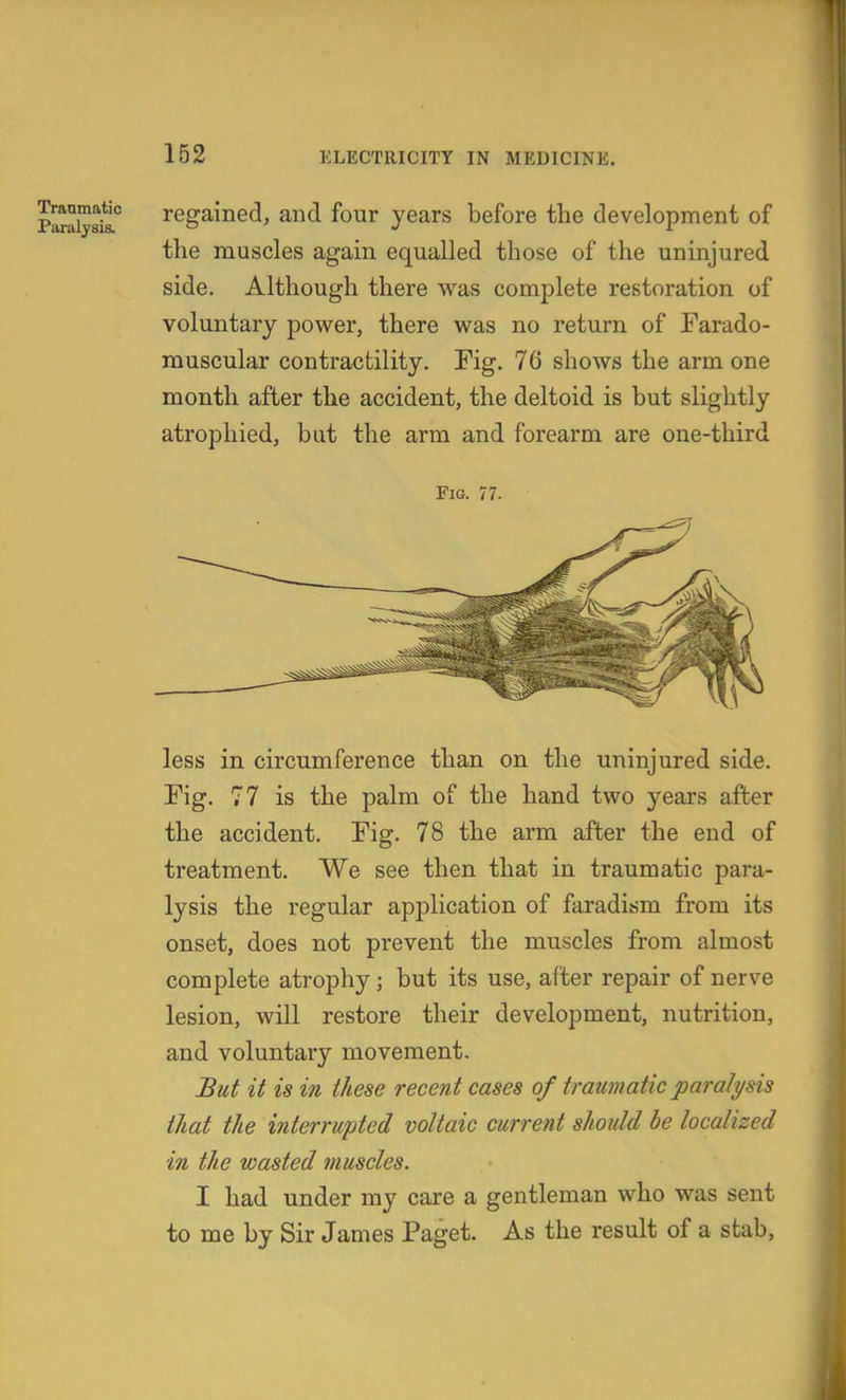 p^iyakT regained, and four years before the development of the muscles again equalled those of the uninjured side. Although there was complete restoration of voluntary power, there was no return of Farado- muscular contractility. Fig. 76 shows the arm one month after the accident, the deltoid is but slightly atrophied, bat the arm and forearm are one-third Fig. 77- less in circumference than on the uninjured side. Fig. 77 is the palm of the hand two years after the accident. Fig. 78 the arm after the end of treatment. We see then that in traumatic paia- lysis the regular application of faradism from its onset, does not prevent the muscles from almost complete atrophy; but its use, after repair of nerve lesion, will restore their development, nutrition, and voluntary movement. But it is in these recent cases of traumatic paralysis that the interrupted voltaic current should be localized in the wasted muscles. I had under my care a gentleman who was sent to me by Sir James Paget. As the result of a stab,