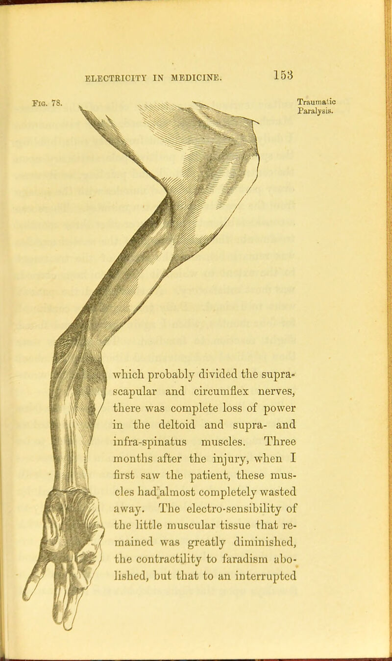 Fig. 78. Traumatic Paralysis. whicli probabl)' divided the supra- scapular and circumflex nerves, there was complete loss of power in the deltoid and supra- and infra-spinatus muscles. Three months after the injury, when I first saw the patient, these mus- cles had'almost completely wasted away. The electro-sensibility of the little muscular tissue that re- mained was greatly diminished, the contractility to faradism abo- lished, but that to an interrupted