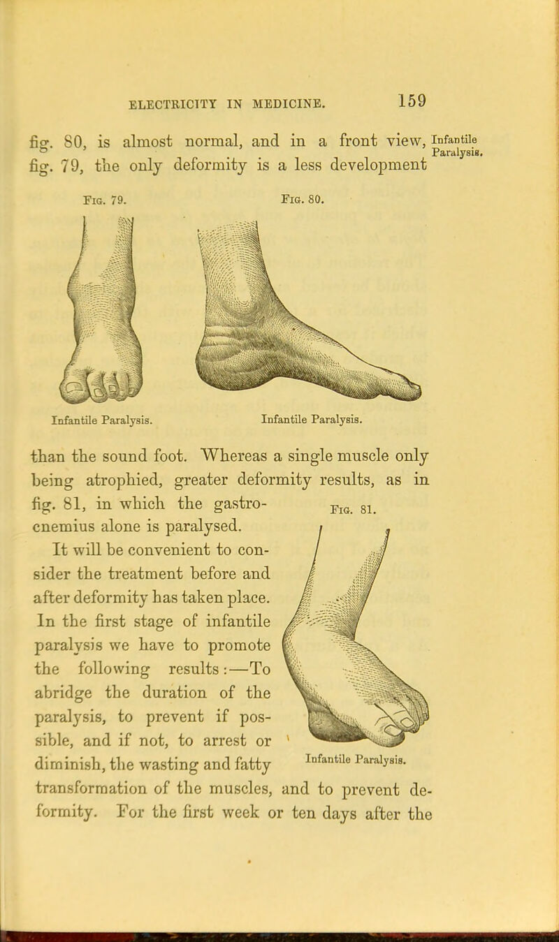 fiff. 80, is almost normal, and in a front view, infantUe o ' ^ Paralysis. fig. 79, the only deformity is a less development Fig. 79. Fig. 80. Infantile Paralysis. Infantile Paralysis. than the sound foot. Whereas a single muscle only being atrophied, greater deformity results, as in fig. 81, in which the gastro- j,^^ gj_ cnemius alone is paralysed. It will be convenient to con- sider the treatment before and after deformity has taken place. In the first stage of infantile paralysis we have to promote the following results :—To abridge the duration of the paralysis, to prevent if pos- sible, and if not, to arrest or ' diminish, the wasting and fatty Paralysis, transformation of the muscles, and to prevent de- formity. For the first week or ten days after the