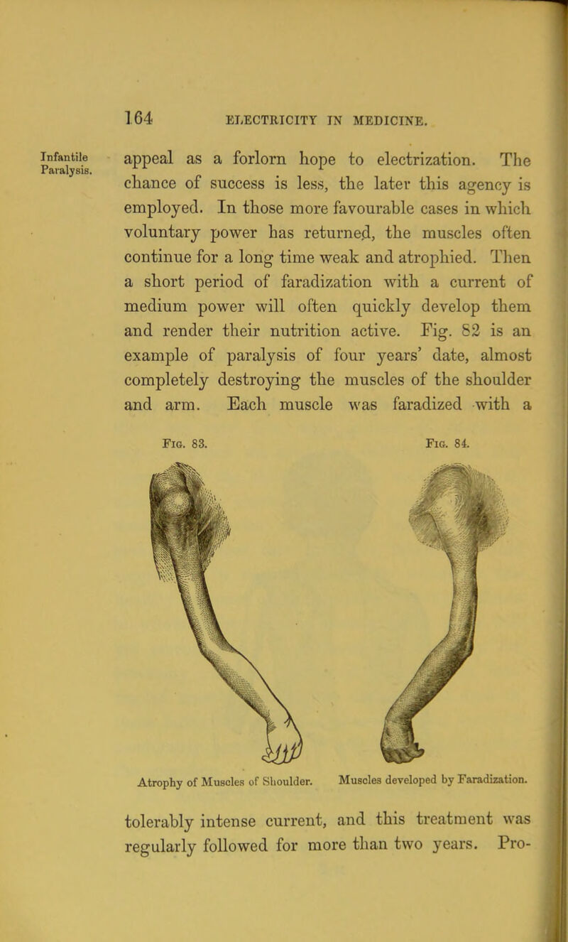 Infantile appeal as a forlorn hope to electrization. The chance of success is less, the later this agency is employed. In those more favourable cases in which voluntary power has returned, the muscles often continue for a long time weak and atrophied. Then a short period of faradization with a current of medium power will often quickly develop them and render their nutrition active. Fig. 52 is an example of paralysis of four years' date, almost completely destroying the muscles of the shoulder and arm. Each muscle was faradized with a Fig. 83. Fig. 84. Atrophy of Muscles of Shoulder. Muscles developed by Faradization. tolerably intense current, and this treatment was regularly followed for more than two years. Pro-