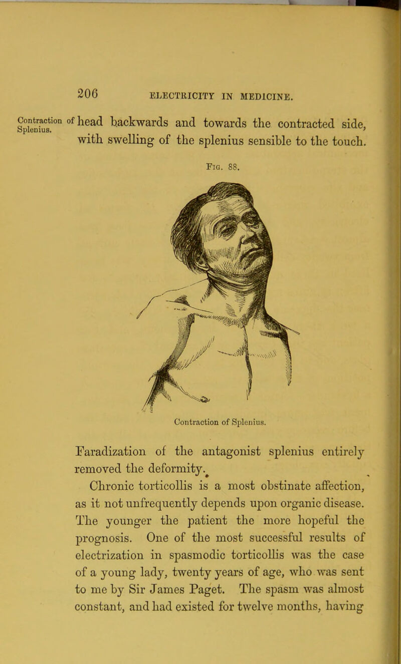 Contraction of head backwards and towards the contracted side. bplenius. ^ ' with swelling of the splenius sensible to the touch. Fig. 88. Contraction of Splenius. Faradization of the antagonist splenius entirely removed the deformity.^ Chronic torticollis is a most obstinate affection, as it not unfrequently depends upon organic disease. The younger the patient the more hopeful the prognosis. One of the most successful results of electrization in spasmodic torticollis was the case of a young lady, twenty years of age, who was sent to me by Sir James Paget. The spasm was almost constant, and had existed for twelve months, having