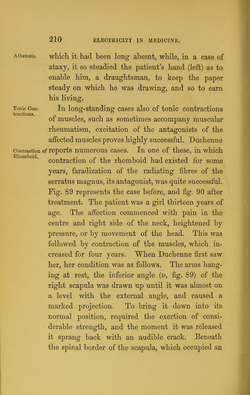 Athetosis, whicli it had been long absent, while, in a case of ataxy, it so steadied the patient's hand (left) as to enable him, a draughtsman, to keep the paper steady on which he was drawing, and so to earn his living. Tonic Con- In long-standing cases also of tonic contractions tractions. n ^ , 01 muscles, such as sometimes accompany muscular rheumatism, excitation of the antagonists of the affected muscles proves highly successful. Duchenne Contraction of rcports uumcrous cascs. In one of these, in which contraction of the rhomboid had existed for some years, faradization of the radiating fibres of the serratus magnus, its antagonist, was quite successful. Fig. 89 represents the case before, and fig. 90 after treatment. The patient was a girl thirteen years of age. The affection commenced with pain in the centre and right side of the neck, heightened by pressure, or by movement of the head. This was followed by contraction of the muscles, which in- creased for four years. When Duchenne first saw her, her condition was as follows. The arras hang- ing at rest, the inferior angle (u, fig. 89) of the right scapula was drawn up until it was almost on a level with the external angle, and caused a marked projection. To bring it down into its normal position, required the exertion of consi- derable strength, and the moment it was released it sprang back with an audible crack. Beneath the spinal border of the scapula, which occupied an