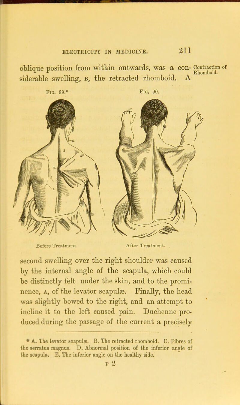 oblique position from within outwards, was a con- Contraction of siderable swelling, b, the retracted rhomboid. A Fig. 89.* Fig. 90. Before Treatment. After Treatment. second swelling over the right shoulder was caused by the internal angle of the scapula, which could be distinctly felt under the skin, and to the promi- nence, A, of the levator scapulae. Finally, the head was slightly bowed to the right, and an attempt to incline it to the left caused pain. Duchenne pro- duced during the passage of the current a precisely * A. The levator scapulte. B. The retracted rhomboid. C. Fibres of the aerratus magnus. D. Abnormal position of the inferior angle of the scapula. E. The inferior angle on the healthy side. p 2