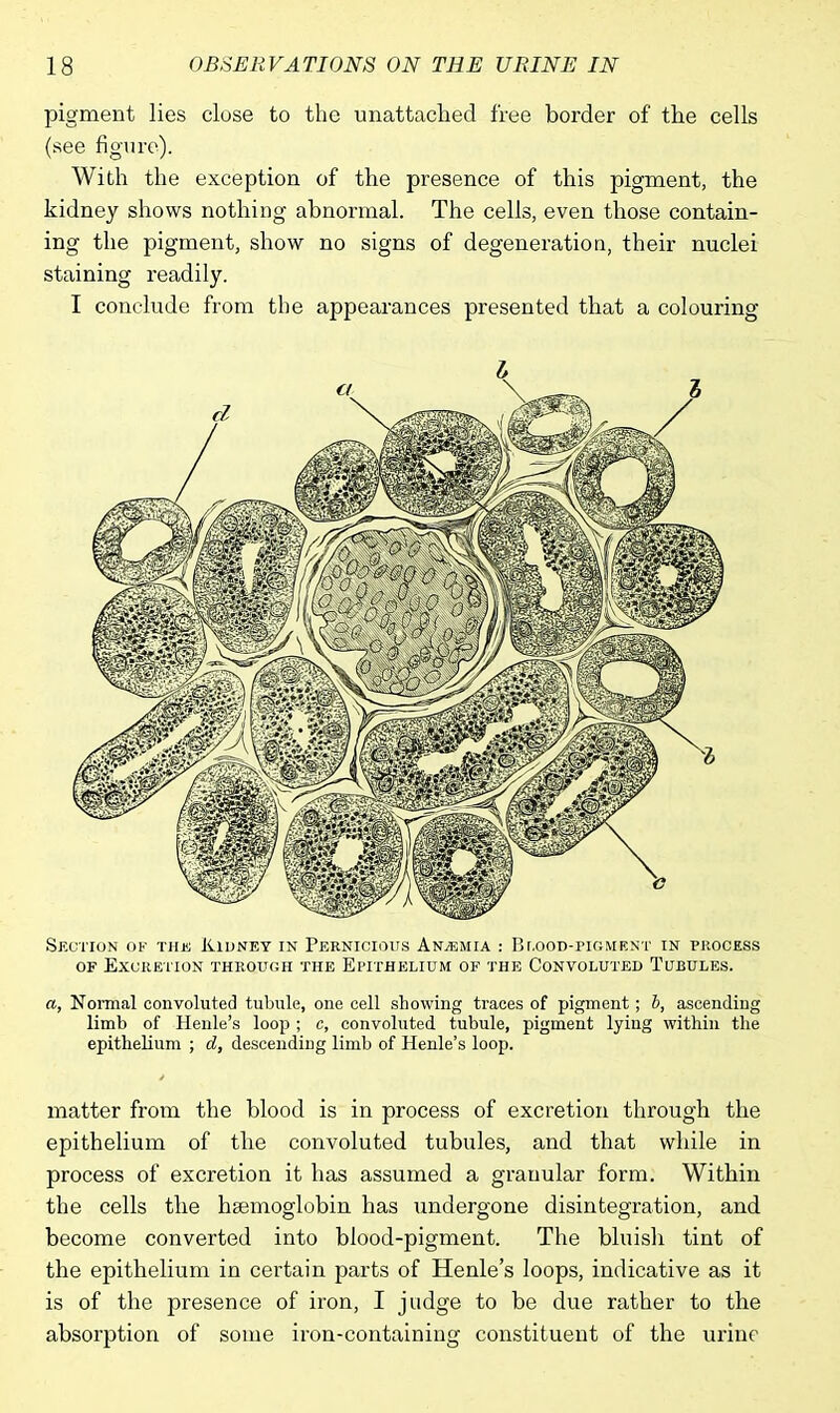 pigment lies close to the unattached free border of the cells (see figure). With the exception of the presence of this pigment, the kidney shows nothing abnormal. The cells, even those contain- ing the pigment, show no signs of degeneration, their nuclei staining readily. I conclude from the appearances presented that a colouring Section of the Kidney in Pernicious Anaemia : Blood-pigment in process of Excretion through the Epithelium of the Convoluted Tubules. a, Normal convoluted tubule, one cell showing traces of pigment; b, ascending limb of Henle's loop ; c, convoluted tubule, pigment lying within the epithelium ; d, descending limb of Henle's loop. matter from the blood is in process of excretion through the epithelium of the convoluted tubules, and that while in process of excretion it has assumed a granular form. Within the cells the haemoglobin has undergone disintegration, and become converted into blood-pigment. The bluish tint of the epithelium in certain parts of Henle's loops, indicative as it is of the presence of iron, I judge to be due rather to the absorption of some iron-containing constituent of the urine