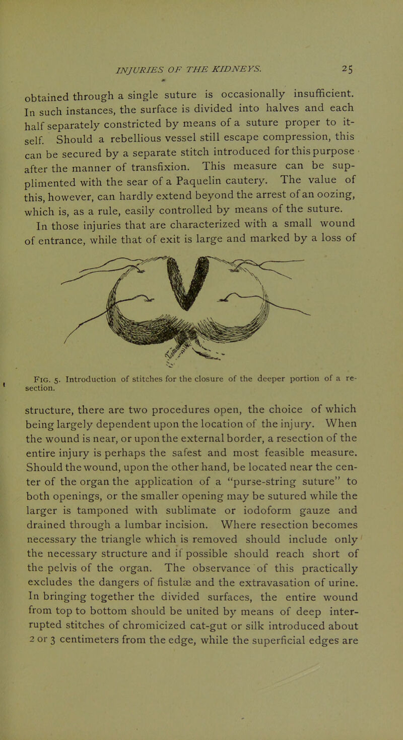 obtained through a single suture is occasionally insufficient. In such instances, the surface is divided into halves and each half separately constricted by means of a suture proper to it- self. Should a rebellious vessel still escape compression, this can be secured by a separate stitch introduced for this purpose after the manner of transfixion. This measure can be sup- plimented with the sear of a Paquelin cautery. The value of this, however, can hardly extend beyond the arrest of an oozing, which is, as a rule, easily controlled by means of the suture. In those injuries that are characterized with a small wound of entrance, while that of exit is large and marked by a loss of Fig. 5. Introduction of stitches for the closure of the deeper portion of a re- section. structure, there are two procedures open, the choice of which being largely dependent upon the location of the injury. When the wound is near, or upon the external border, a resection of the entire injury is perhaps the safest and most feasible measure. Should the wound, upon the other hand, be located near the cen- ter of the organ the application of a purse-string suture to both openings, or the smaller opening may be sutured while the larger is tamponed with sublimate or iodoform gauze and drained through a lumbar incision. Where resection becomes necessary the triangle which is removed should include only the necessary structure and if possible should reach short of the pelvis of the organ. The observance of this practically excludes the dangers of fistulae and the extravasation of urine. In bringing together the divided surfaces, the entire wound from top to bottom should be united by means of deep inter- rupted stitches of chromicized cat-gut or silk introduced about 2 or 3 centimeters from the edge, while the superficial edges are