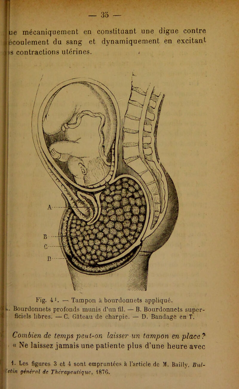 — 3Ô — je mécaniquement en constituant une digue contre îcoulement du sang et dynamiquement en excitant s contractions utérines. i V. Combien de temps peut-on laisser un tampon en place? « Ne laissez jamais une patiente plus d’une heure avec Les figures 3 et 4 sont empruntées à l’article de M. Bailly. Biil- tfe/in général de Thcrafieuligue, 1876. Fig. 4*. — Tampon à bourdonnets appliqué. Bourdonnets profonds munis d’un fil. — B. Bourdonnets super- ficiels libres. — C. Gâteau de charpie. — D. Bandage en T.