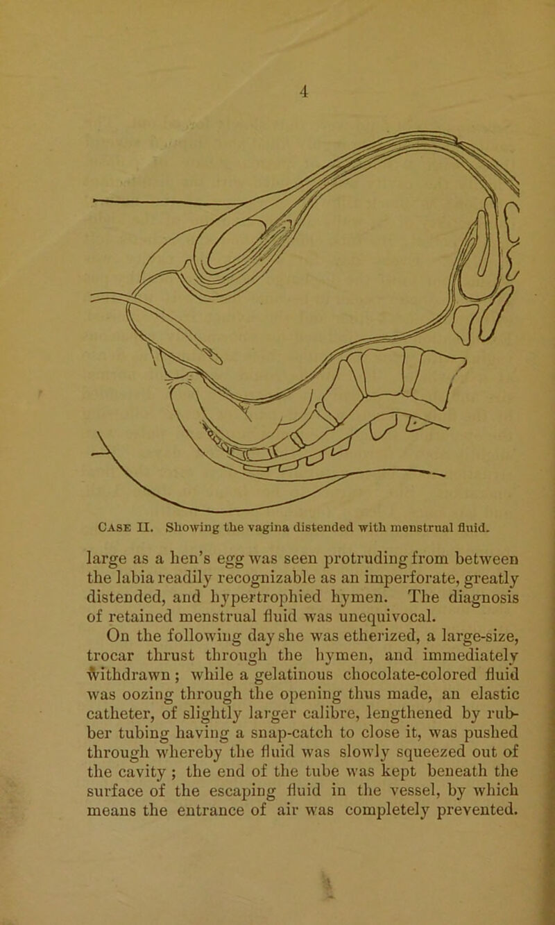 Case II. Showing the vagina distended with menstrual fluid. large as a lien’s egg was seen protruding from between the labia readily recognizable as an imperforate, greatly distended, and hypertrophied hymen. The diagnosis of retained menstrual fluid was unequivocal. On the following day she was etherized, a large-size, trocar thrust through the hymen, and immediately Withdrawn ; while a gelatinous chocolate-colored fluid was oozing through the opening thus made, an elastic catheter, of slightly larger calibre, lengthened by rub- ber tubing having a snap-catch to close it, was pushed through whereby the fluid was slowly squeezed out of the cavity ; the end of the tube was kept beneath the surface of the escaping fluid in the vessel, by which means the entrance of air was completely prevented. %