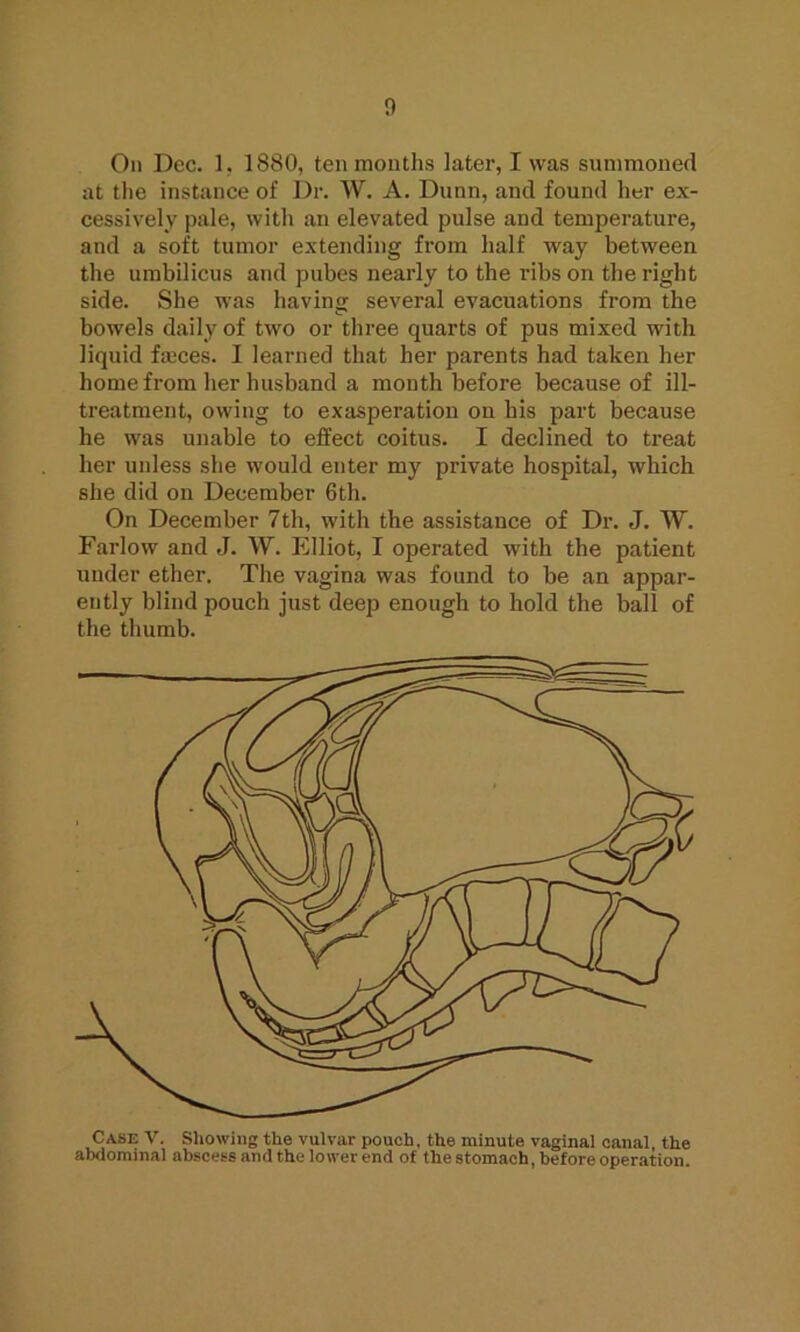 On Dec. 1. 1880, ten months later, I was summoned at the instance of Dr. W. A. Dunn, and found her ex- cessively pale, with an elevated pulse and temperature, and a soft tumor extending from half way between the umbilicus and pubes nearly to the ribs on the right side. She was having several evacuations from the bowels daily of two or three quarts of pus mixed with liquid faeces. I learned that her parents had taken her home from her husband a month before because of ill- treatment, owing to exasperation on his part because he was unable to effect coitus. I declined to treat her unless she would enter my private hospital, which she did on December 6th. On December 7th, with the assistance of Dr. J. W. Farlow and J. W. Elliot, I operated with the patient under ether. The vagina was found to be an appar- ently blind pouch just deep enough to hold the ball of the thumb.