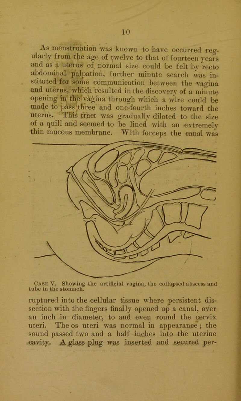 Case V. Showing the artificial vagina, the collapsed abscess and tube in the stomach. ruptured into the cellular tissue where persistent dis- section with the fingers finally opened up a canal, over an inch in diameter, to and even round the cervix uteri. The os uteri was normal in appearance ; the sound passed two and a half inches into the uterine cavity. A glass plug was inserted and secured per- As menstruation was known to have occurred reg- ularly from the age of twelve to that of fourteen years and as a uterus of normal size could be felt by recto abdominal palpation, further minute search was in- stituted for some communication between the vftgiaa and uterus, which resulted in the discovery of a minute opening in1 the vagina through which a wire could be made to passhh'ree and one-fourth inches toward the uterus. TBis tract was gradually dilated to the size of a quill and seemed to be lined’ with an extremely thin mucous membrane. With forceps the canal was