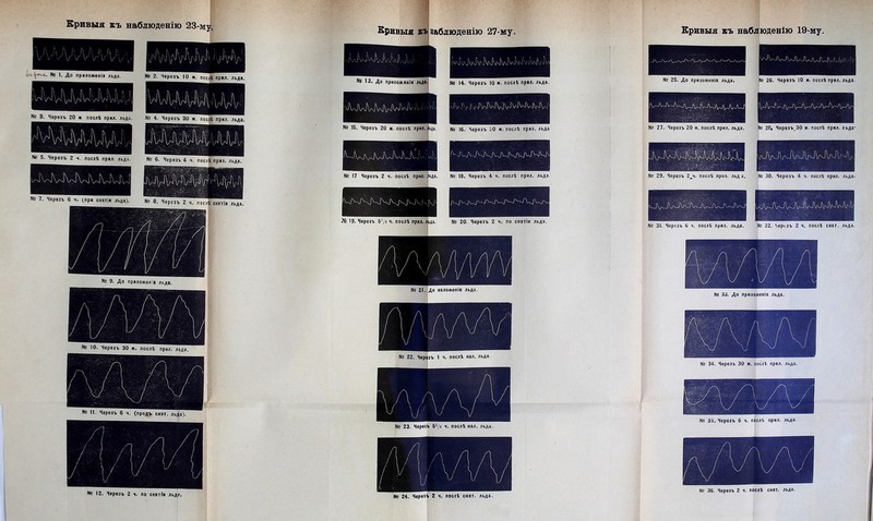 1 Крнвыя въ вабдюденію 27-му. Кривыя къ наблюденію 19-му. Кривыя къ наблюденію 23-му. , , . к *' А *. і‘і Гі ! у\г\гѴ\г\! і-'\г (и. № 1. До пршяожвнія льда № 2. Черезъ 10 м. посЛ прял. льд». N° 3. Черезъ 20 ■ послѣ прял, льда. N° 4. Черезъ 30 *. посіі прял. льда. N6 5. Черезъ 2 ч. послѣ прял. льда. № 6. Черезъ 4 ч. послѣ прял. льда. № 7. Черезъ 6 ч. спря снятія льда). № 8. Черезъ 2 ч. послѣ снятія льда N2 10. Черезъ 30 м. послѣ прил. льда. N2 12. Черезъ 2 ч. по снятГи льд?. '3. До приложенія льда.! № 14. Черезъ 10 *. послѣ прял. льда. N9 15. Черезъ 20 к. послѣ прил. льда. мд 16. Черезъ 50 м. послѣ прил. льда № 17 Черезъ 2 ч. послѣ прил. льда. № 18. Черезъ 4 ч. послѣ прил. льда. № 19. Черезъ ч. послѣ прил. льда. № 20. Черезъ 2 ч. по снятіи льда. № 21. До наложенія льда. № 22. Черезъ 1 ч. послѣ нал. льда. і № 23. Черезъ б^/з ч. послѣ нал. льда. № 24. Черезъ 2 ч. послѣ снят. льда. № 25. До приложенія льда. ■X'.гО -і'ѵгѵ^’ѵ^іДігч) № 26. Черезъ 10 м. послѣ прил. льда. № 27. Черезъ 20 м. послѣ прнл. льда. № 2Р« Чѳрѳзъ^ЗО м. послѣ прил. льда* № 29. Черезъ 2^ч. послѣ прил. льд а. № 30. Черезъ 4 ч. послѣ прил. льда. № 31. Черезъ 6 ч. послѣ прил. льда. № 32. Черезъ 2 ч. послѣ снят. льда. № 33. До прилоінѳкія льда. № 34. Черезъ 30 м. послѣ прил. льда. № 35. Черезъ 6 ч. послѣ прнл. льда. № 36. Черезъ 2 ч. послѣ снят. льда.