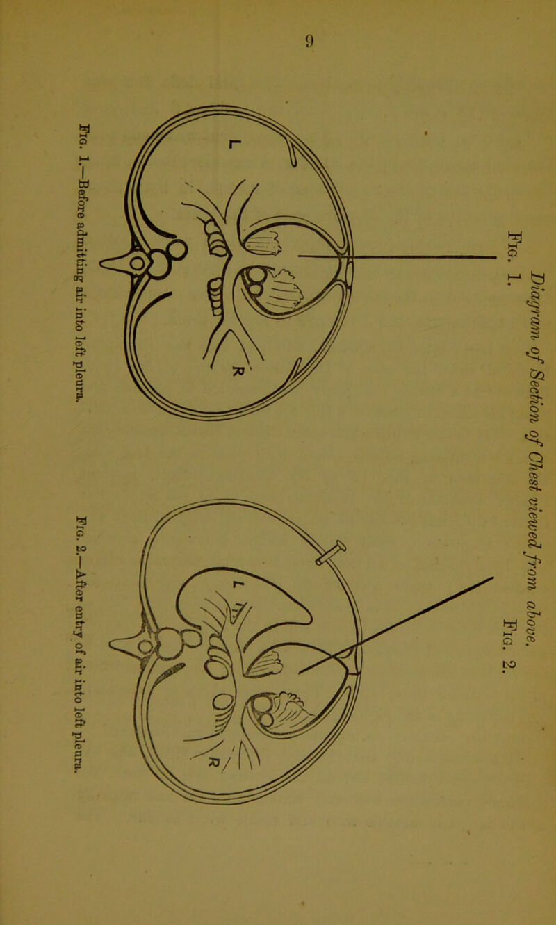 Fig. 1. Before admitting air into left pleura. Fig. 2.—After entry of air into left pleura. Diagram of Section of Chest viewed from above. Fig. 1. Fig.