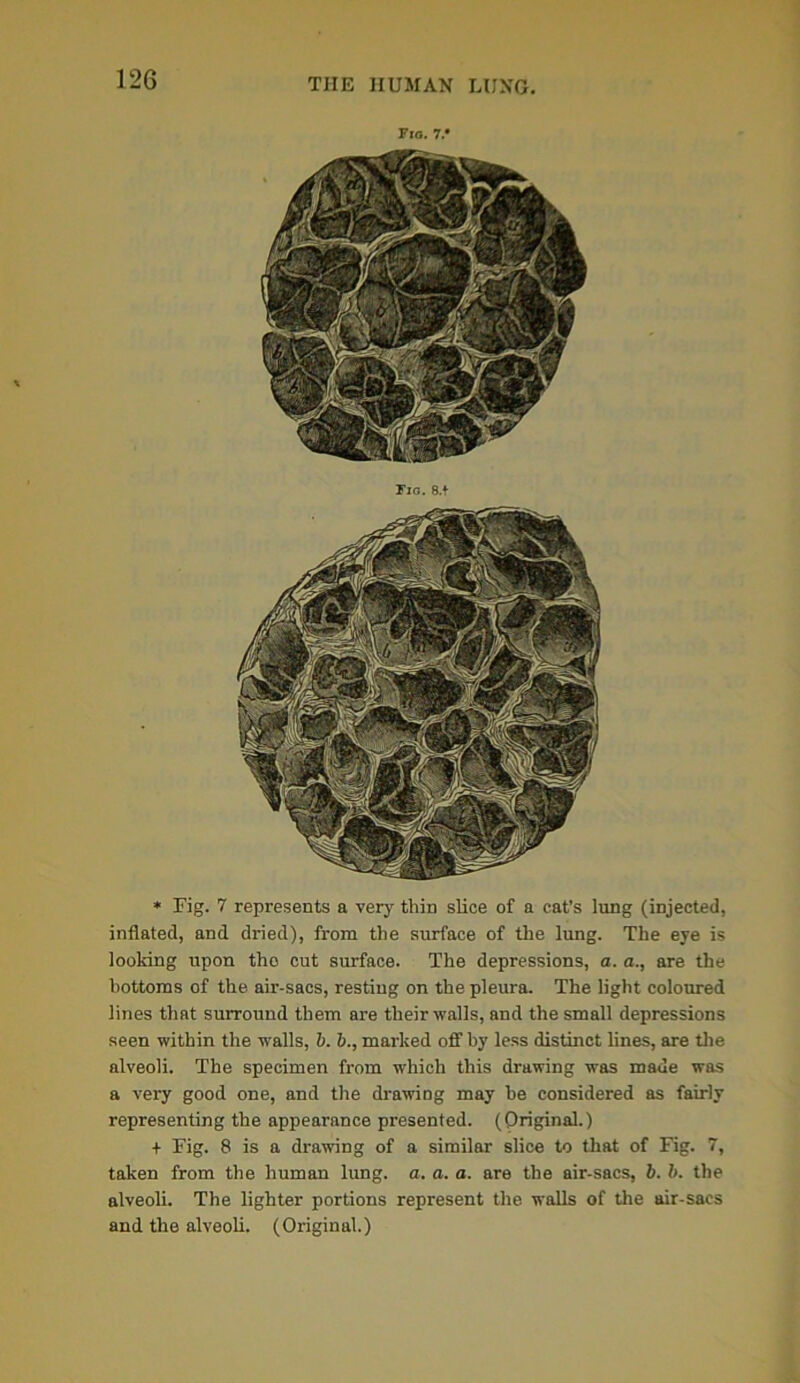 Fig. 7.* * Fig. 7 represents a very thin slice of a cat’s lung (injected, inflated, and dried), from the surface of the lung. The eye is looking upon tho cut surface. The depressions, a. a., are the bottoms of the air-sacs, resting on the pleura. The light coloured lines that surround them are their walls, and the small depressions seen within the walls, b. &., marked off by less distinct lines, are the alveoli. The specimen from which this drawing was made was a very good one, and the drawing may he considered as fairly representing the appearance presented. (Original.) + Fig. 8 is a drawing of a similar slice to that of Fig. 7, taken from the human lung. a. a. a. are the air-sacs, b. b. the alveoli. The lighter portions represent the walls of the air-sacs and the alveoli. (Original.)